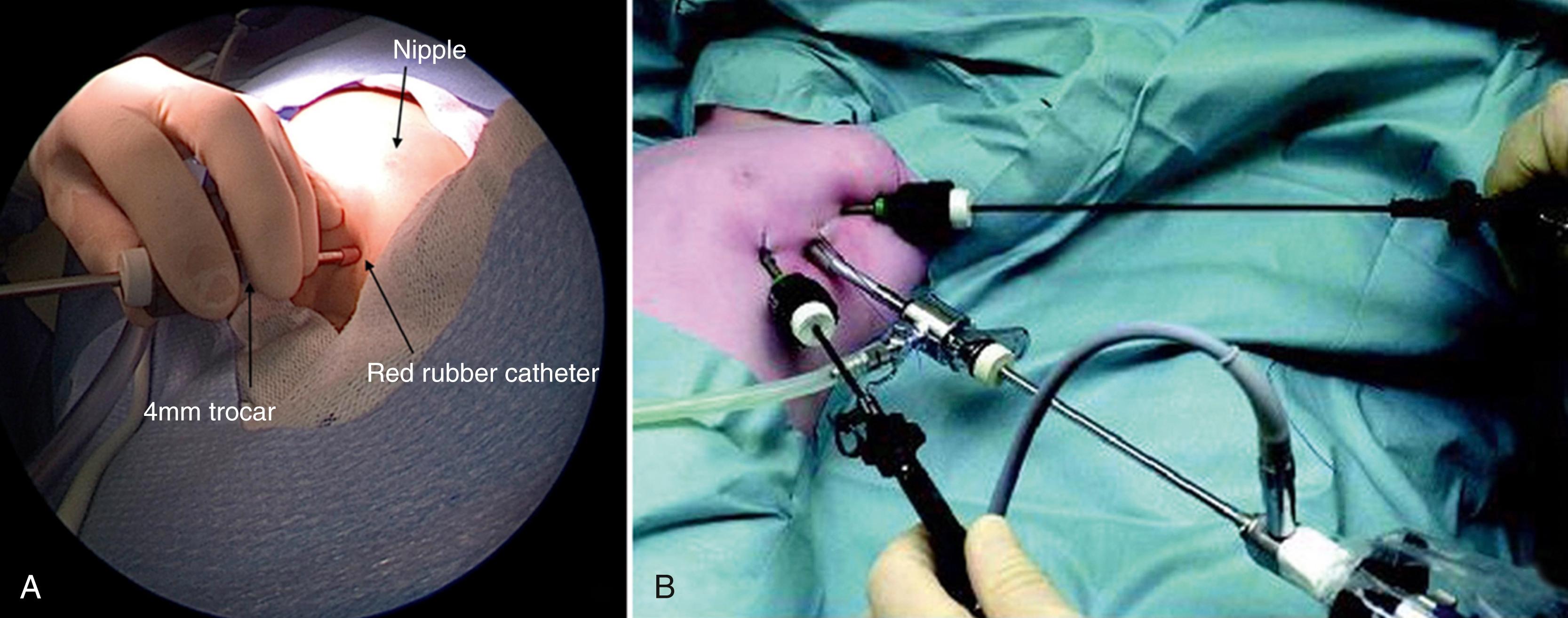 Fig. 38-3, A, A 4-mm port is being inserted in the anterior axillary line at the level of the nipple. The telescope/camera will be inserted through this cannula. B, The photograph shows all three ports in place. Two additional cannulas (3 or 5 mm) are inserted under thoracoscopic visualization, one cephalad to the initial port and one caudal and slightly anterior to the initial cannula. The working angles between these ports should be about 60 to 90 degrees. The upper port is exchanged for a 5-mm expandable port as necessary. All cannulas are secured to the thoracic wall to prevent dislodgment.