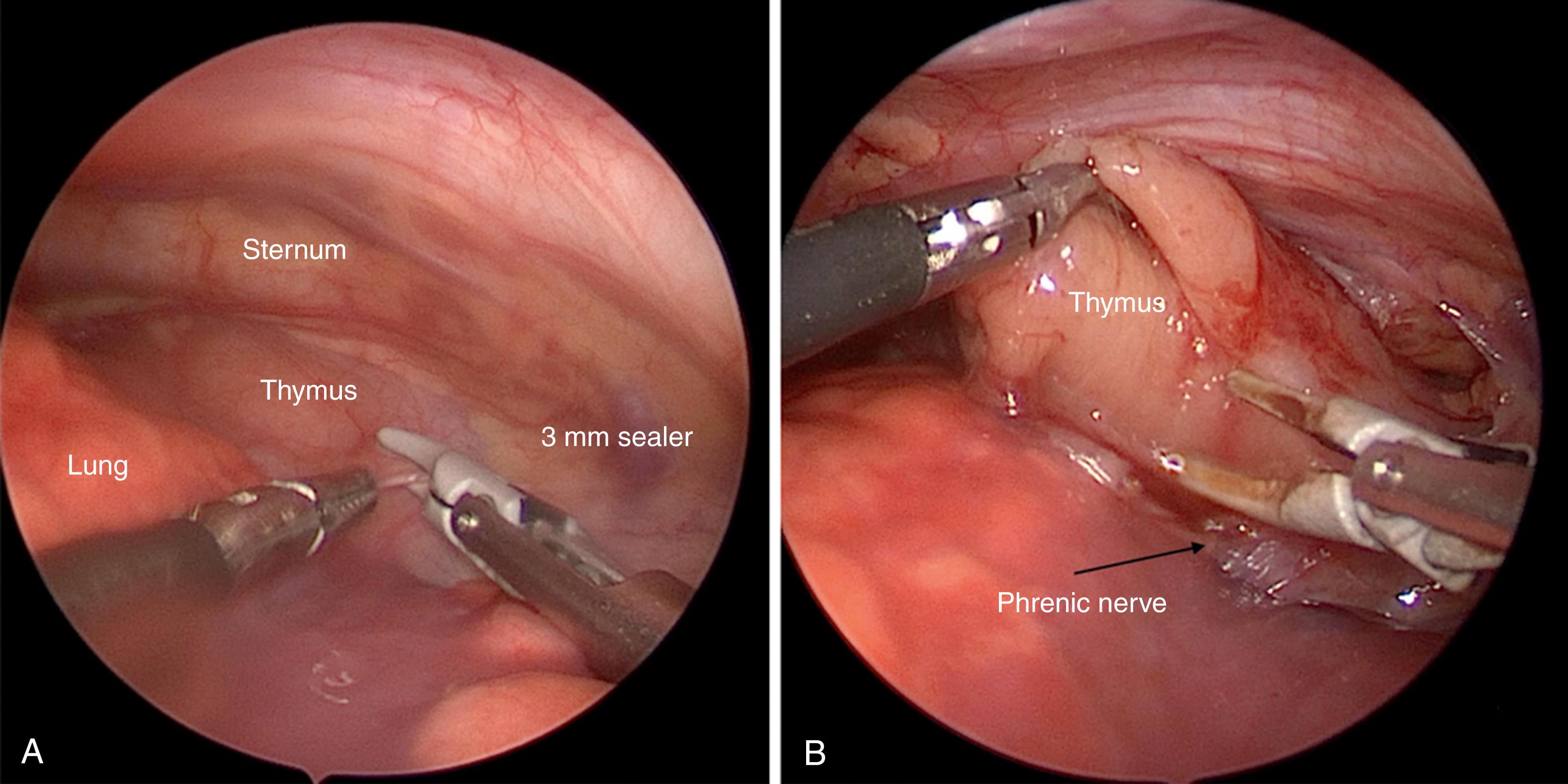 Fig. 38-4, A, The left lobe of the thymus is seen lying below the sternum and anterior to the pericardium. B, The mediastinal pleura between the internal mammary vessels anteriorly and the phrenic nerve posteriorly has been opened with the 3-mm sealer. The left lobe of thymus is mobilized using the 3-mm sealer.