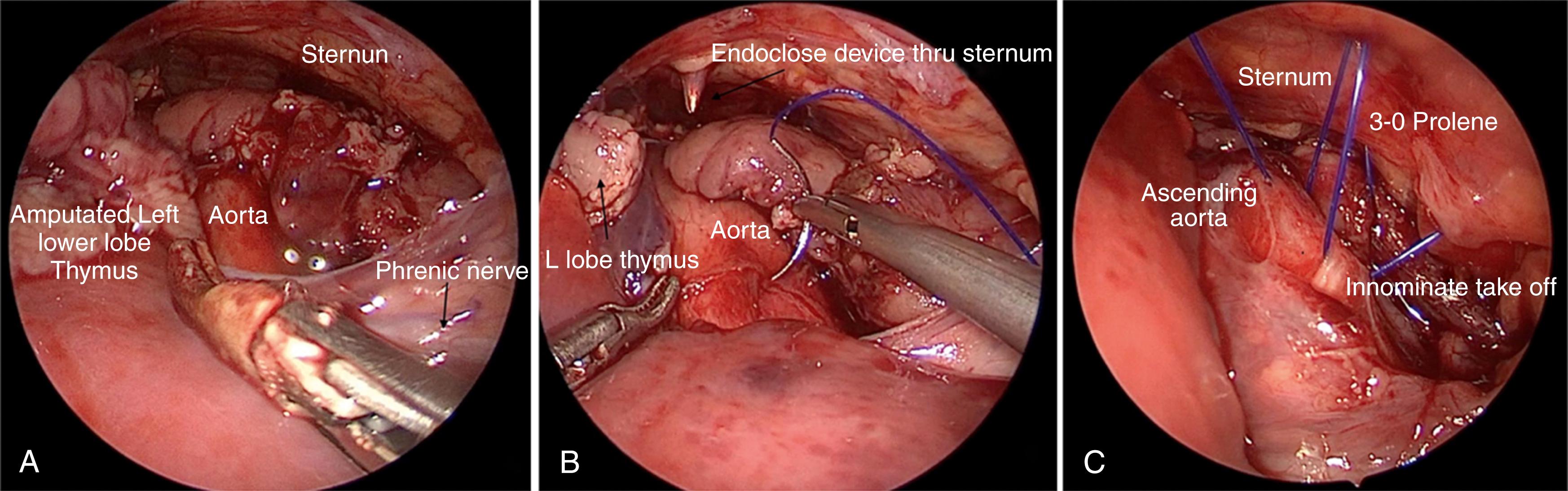 Fig. 38-5, A, The aortic arch and takeoff of the innominate artery are seen with the left lobe of the thymus mobilized. B, The initial stitch (3-0 polydioxanone) is being placed on the ascending aorta near the pericardial reflection. The Endo-Close device will be used to pull the suture up through the sternum. C, The three sutures on the aortic wall have now been placed and exteriorized. Tension will be applied to all three sutures as they are being tied. Tracheobronchoscopy will be performed to ensure an effective aortopexy.