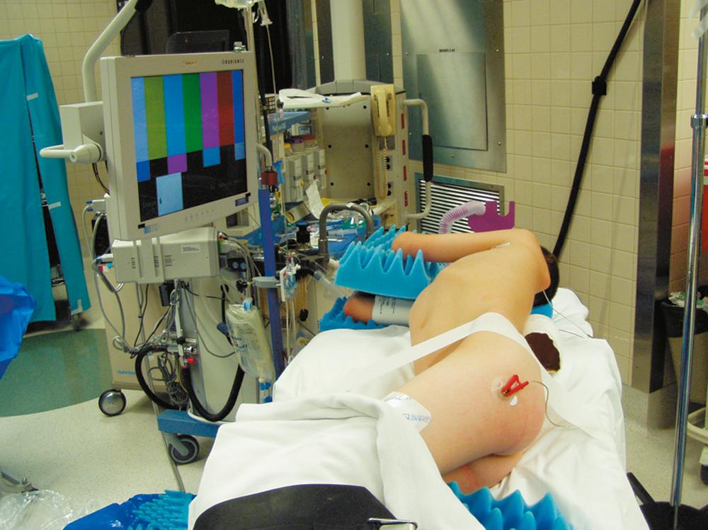 Fig. 36-2, The patient is positioned in a right lateral decubitus position for a left middle mediastinal biopsy. The operating table may be gently flexed at the iliac crest to enlarge the intercostal spaces. A bean bag may be advantageous to help support larger patients.