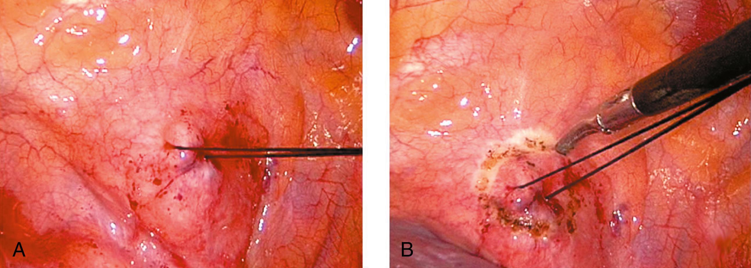 Fig. 36-4, A, A silk suture has been placed in a figure-eight fashion through the mass to be biopsied to help manipulate the specimen without traumatizing it. B, The biopsy site is being outlined with a Maryland dissecting instrument connected to cautery.