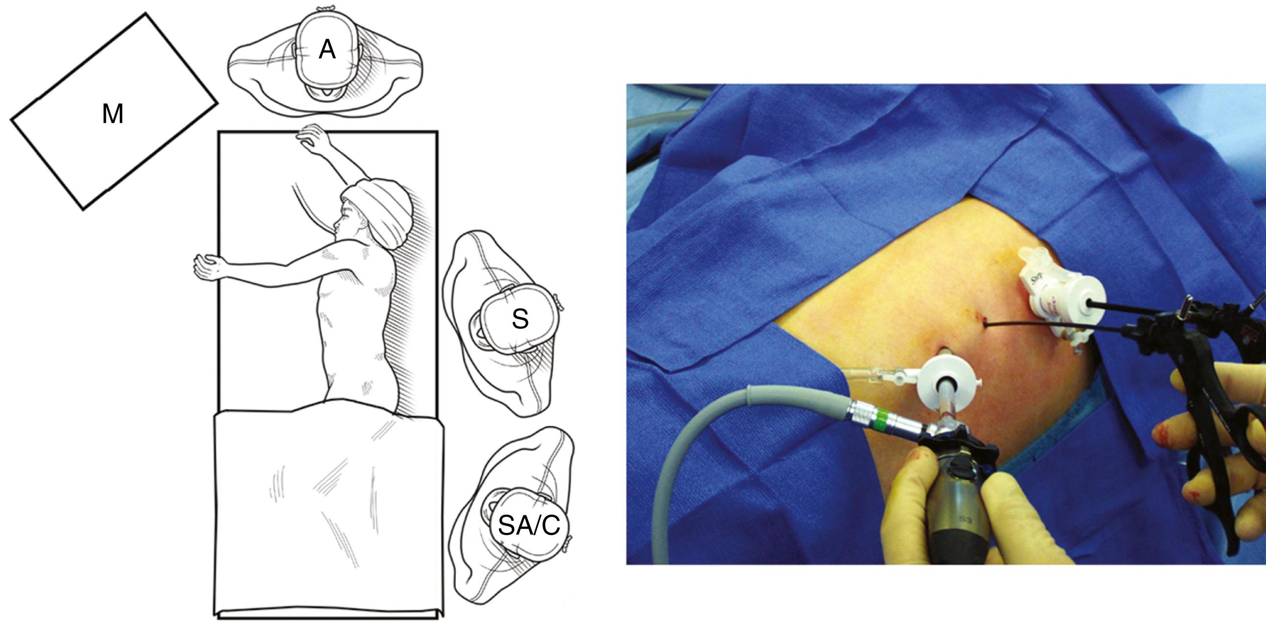 Fig. 36-3, For biopsy of a mediastinal mass, whether in the anterior, posterior, or middle mediastinum, the surgeon (S) and surgical assistant/camera holder (SA/C) stand at the patient’s back, with the monitor (M) positioned opposite them. For biopsy of a middle mediastinal mass, as is being performed in the photograph, a 5-mm valved cannula is introduced in the fourth or fifth intercostal space in the midaxillary line. After insufflation, additional 5-mm valved ports or instruments introduced through stab incisions are placed between the anterior and posterior axillary lines to triangulate the lesion. An angled telescope is used. A, anesthesiologist.