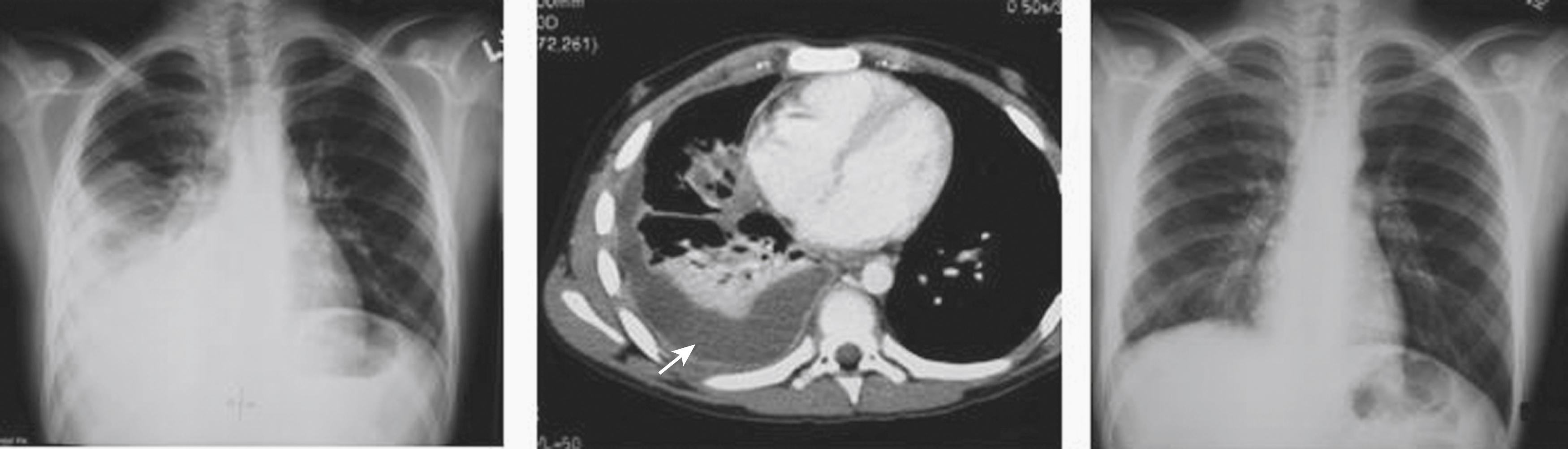 Fig. 34-1, This 10-year-old was found to have a right parapneumonic infusion on chest radiograph ( left ). A computed tomography scan was performed and revealed fluid ( arrow ) loculated in the right base ( center ). However, septations were also identified and the patient required thoracoscopic debridement and decortication. Six weeks after the operation, the chest radiograph ( right ) is completely clear.