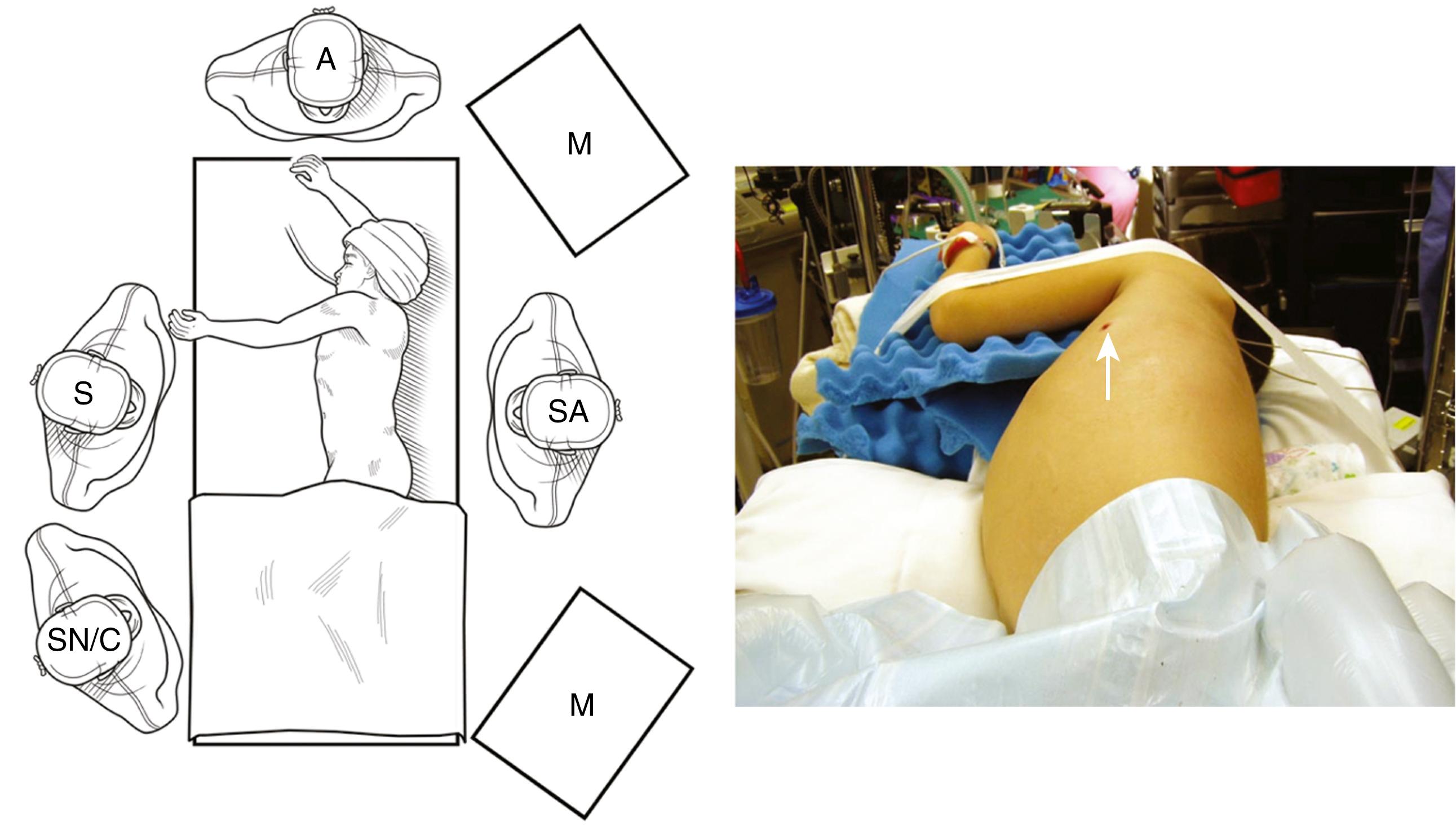 Fig. 34-3, For a thoracoscopic debridement and decortication, the surgeon (S) and surgical assistant (SA) stand on either side of the patient. Usually, the scrub nurse holds the camera (SN/C). A monitor (M) is positioned at the head and at the foot of the operating table because the entire thoracic cavity is usually affected by the empyema. In the patient shown, an attempt was made at initial fibrinolytic therapy through a small chest drain. However, this was unsuccessful and the patient was taken to the operating room for a thoracoscopic debridement and decortication. Such patients are placed in a lateral decubitus position, as shown. Note the site where the chest drain was removed ( arrow ). A, anesthesiologist.