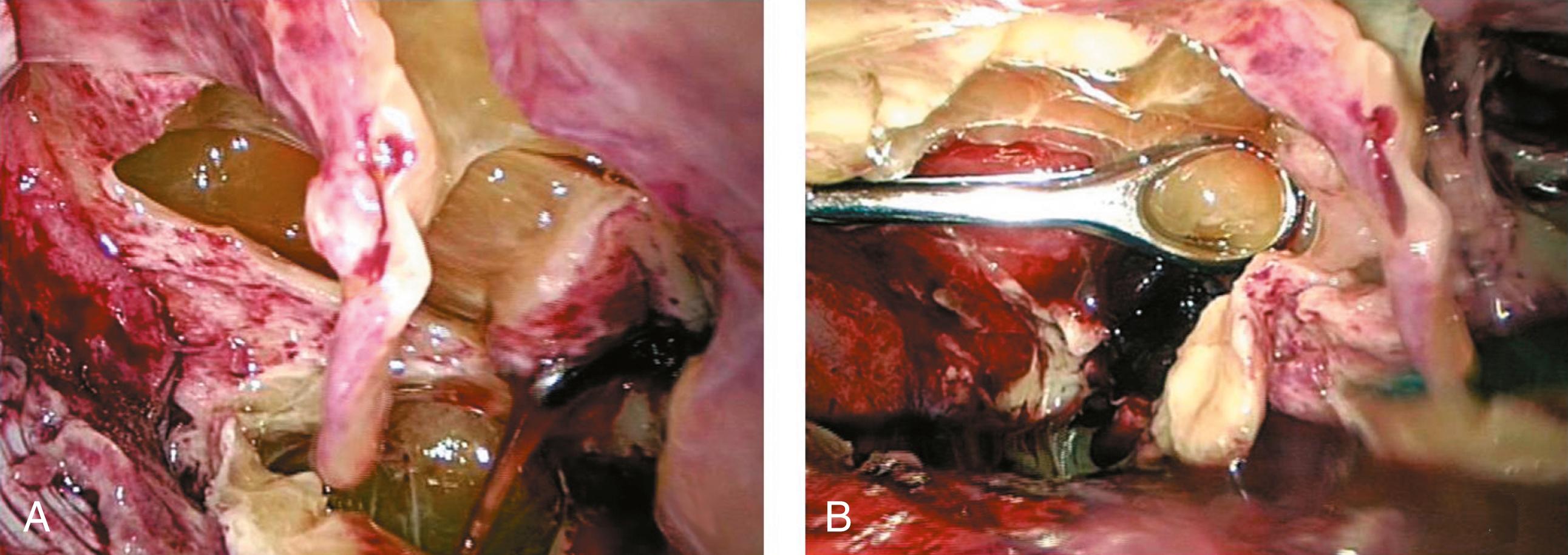 Fig. 34-5, Typical appearance in a patient with empyema. A, Note the thick fibrinous exudate hanging from the parietal pleura. B, Ring forceps have been introduced through a 10-mm incision to allow extensive grasping of the purulent exudate. Note the collapsed lung at the bottom of the photograph.