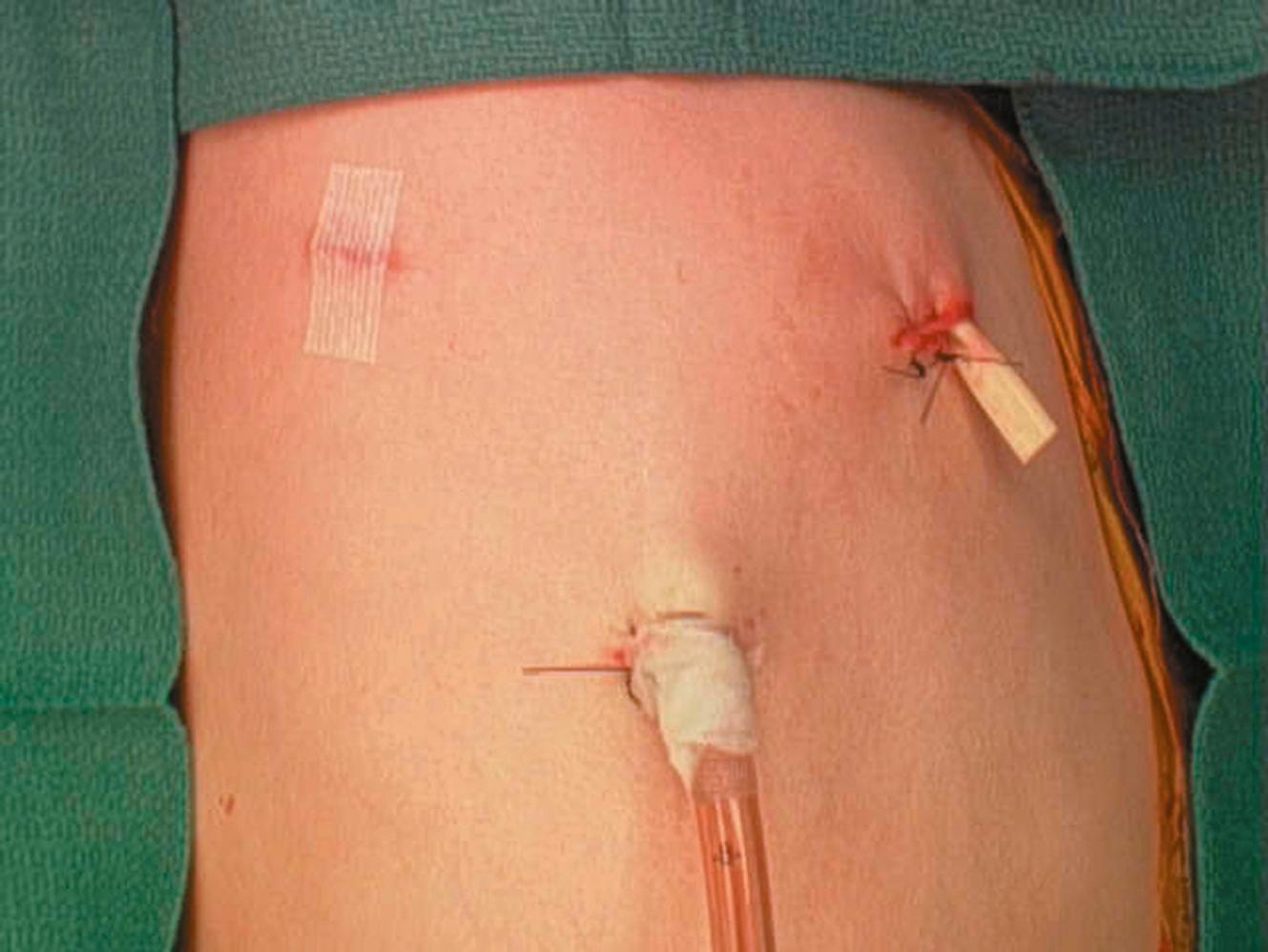 Fig. 34-6, The chest tube is usually exteriorized through the most inferior working site. To help prevent a postoperative infection, the latex drain was left in one of the working incisions as this site was previously used for insertion of a chest tube.