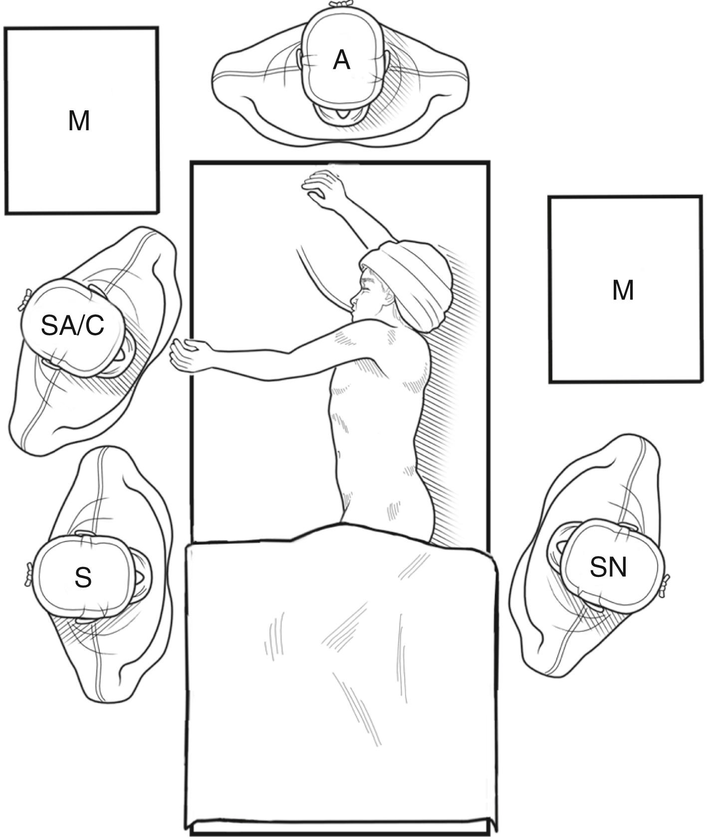 Fig. 32-1, The room and personnel setup for a left lower lobectomy. The surgeon ( S ) and surgical assistant/camera holder ( SA/C ) stand at the patient’s front, with the monitor ( M ) over the patient’s back. The scrub nurse ( SN ) can be positioned at the discretion of the surgeon. If the scrub nurse is positioned opposite the surgeon, as shown here, a second monitor may be helpful for viewing by the scrub nurse. A, anesthesiologist.