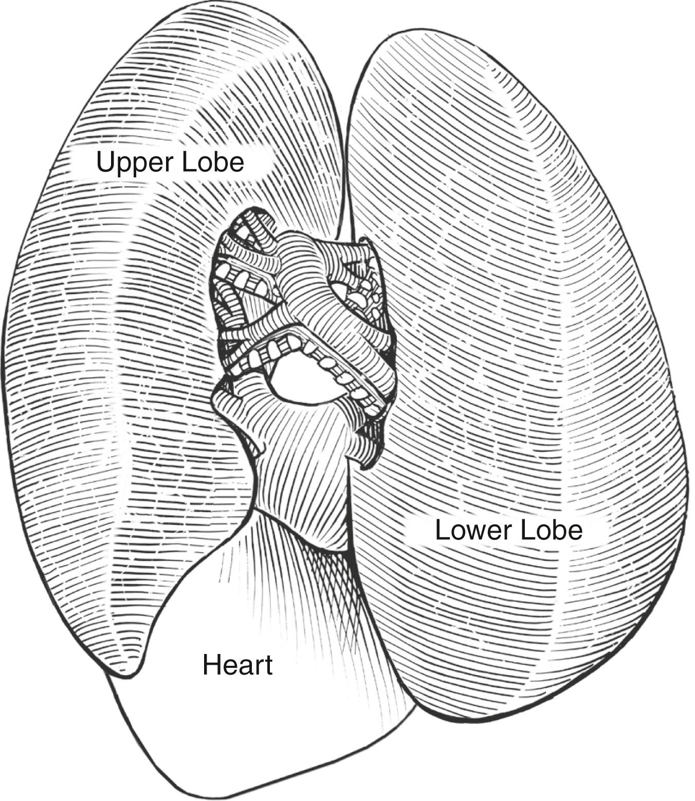 Fig. 32-2, The anatomy seen by the surgeon when the contents of the fissure between the left upper and lower lobes are exposed. The arteries are visualized first within the fissure, and the bronchial structures are behind the arteries. The pulmonary veins exit from the inferior portion of these lobes and drain into the heart.