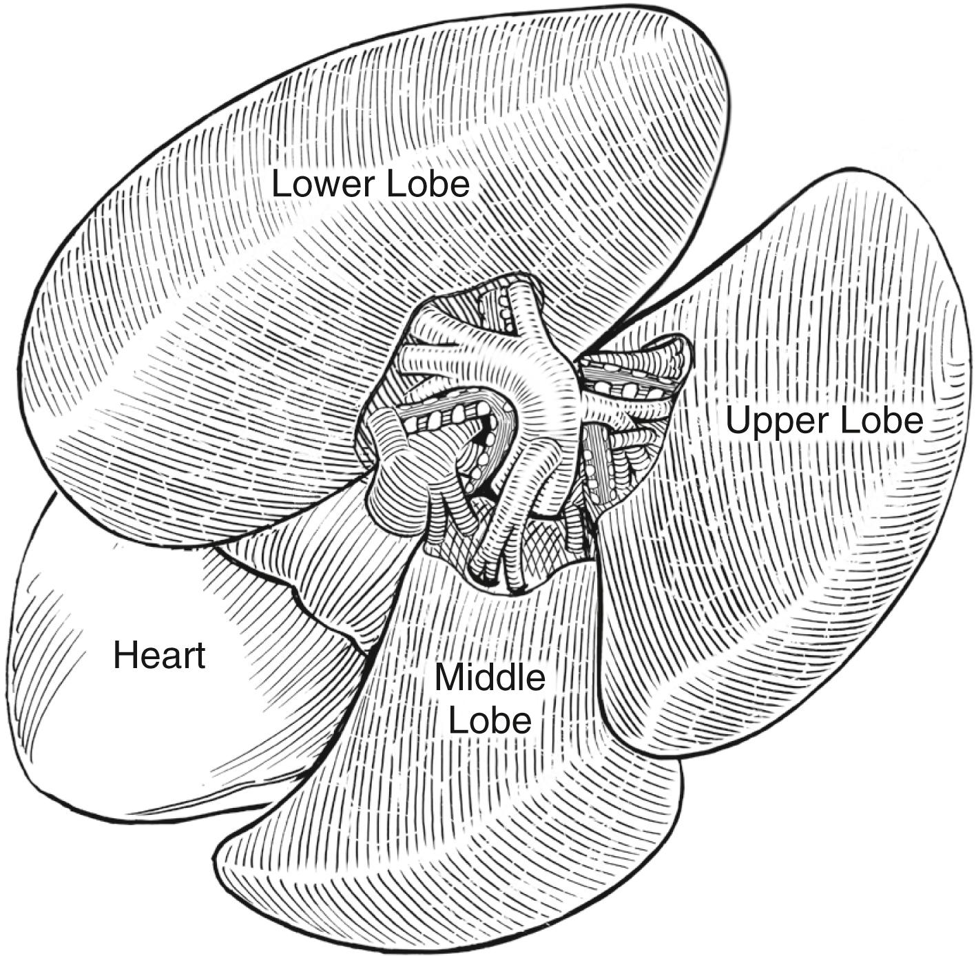 Fig. 32-3, The anatomy as seen by the surgeon when dissecting in the major and minor fissures of the right lung. The arteries are the first structures seen in the fissure, and the bronchial structures are behind the arteries. The pulmonary veins are inferior to the arteries and bronchial structures and drain into the heart.