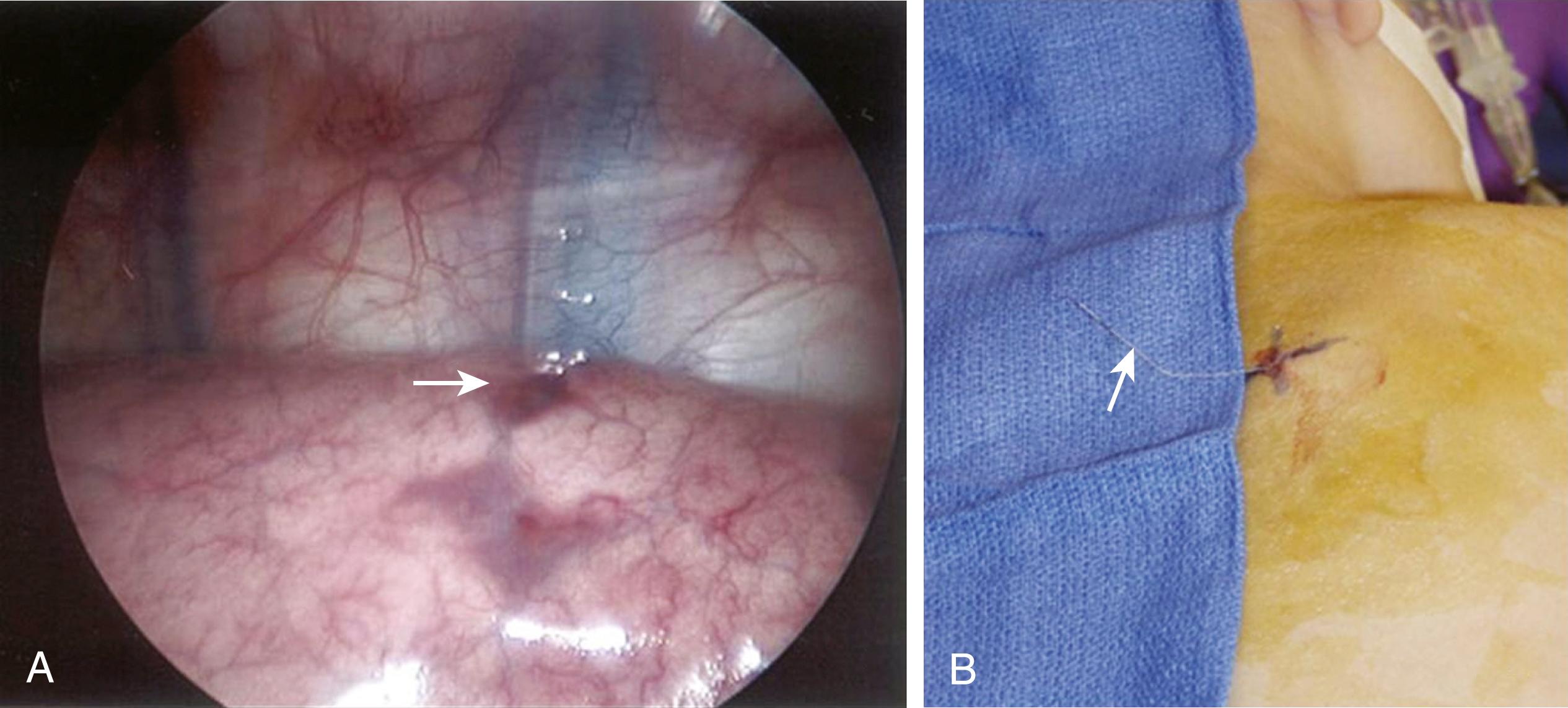 Fig. 31-1, It is often necessary to mark lesions deep to the visceral pleural surface. A number of techniques are available. A, Thoracoscopic visualization of a small blood patch that has been placed over the lesion (arrow) by the radiologist. B, A small wire (arrow) has been introduced into the lesion by the radiologist and is seen exiting the patient’s skin.