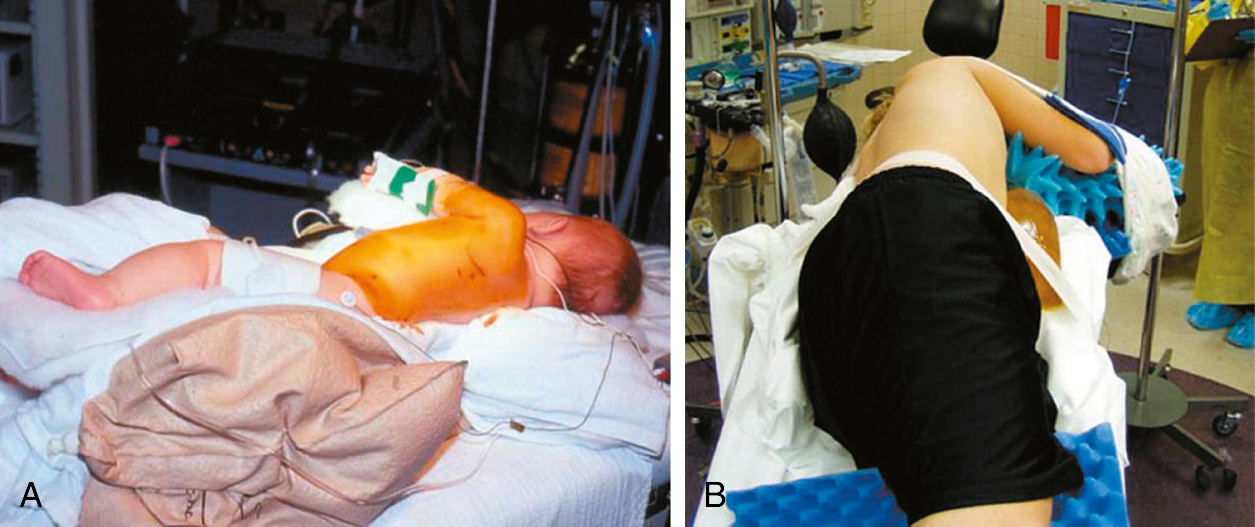 Fig. 31-2, Patients are usually positioned in a lateral decubitus position for a thoracoscopic lung biopsy. A small child ( A ) and an adolescent ( B ) are positioned for a biopsy.