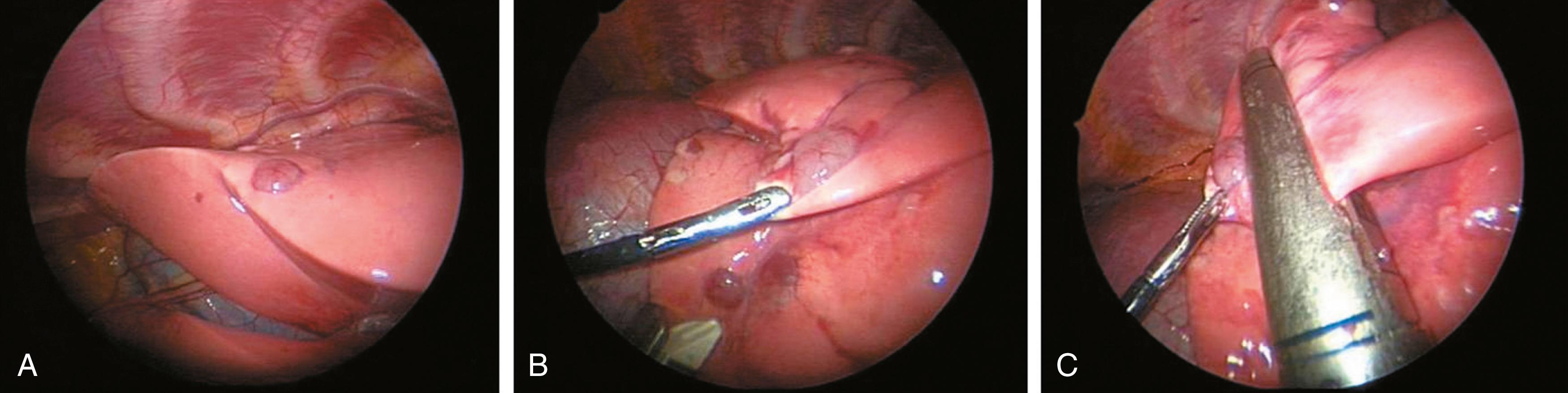 Fig. 31-5, A 5-year-old with a Wilms tumor developed suspected metastatic lesions in the left upper lobe. A, The lesion is visualized on the inferior border of the left upper lobe. B, The edge of the left upper lobe is grasped to place the desired specimen on stretch. C, The stapler is then situated across the base of the lung containing the desired specimen and fired. As in this case, more than one firing often is required to remove the desired lesion.