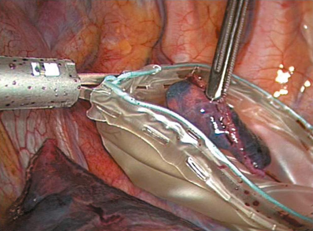 Figure 31-6, Placement of the specimen into an endoscopic retrieval bag should reduce or eliminate the possibility of port site contamination.