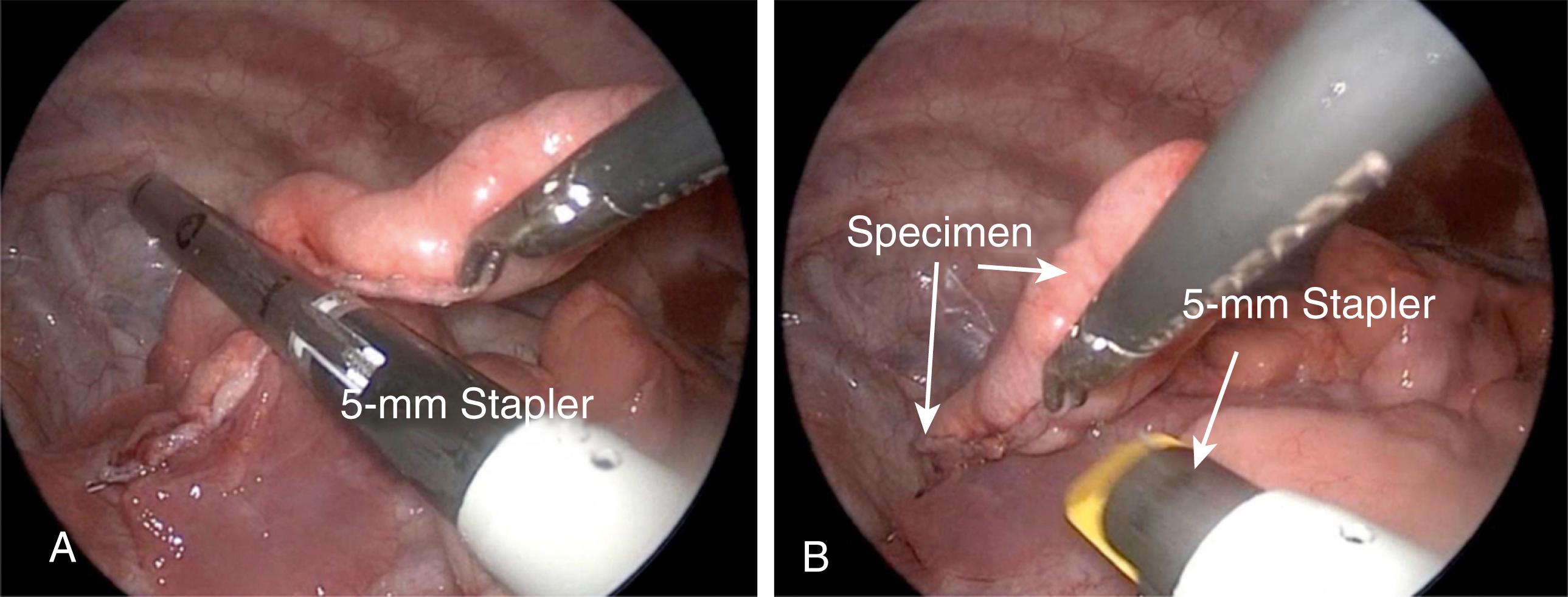 Figure 31-7, In infants less than 15 kg, the 5-mm stapler can be used to perform a lung biopsy. A, The first application of the 5-mm stapler across the anterior basal segment of the right lower lobe in a patient with severe interstitial lung disease is shown. B, The biopsy is completed with a second application of the stapler. The specimen is now ready for removal.