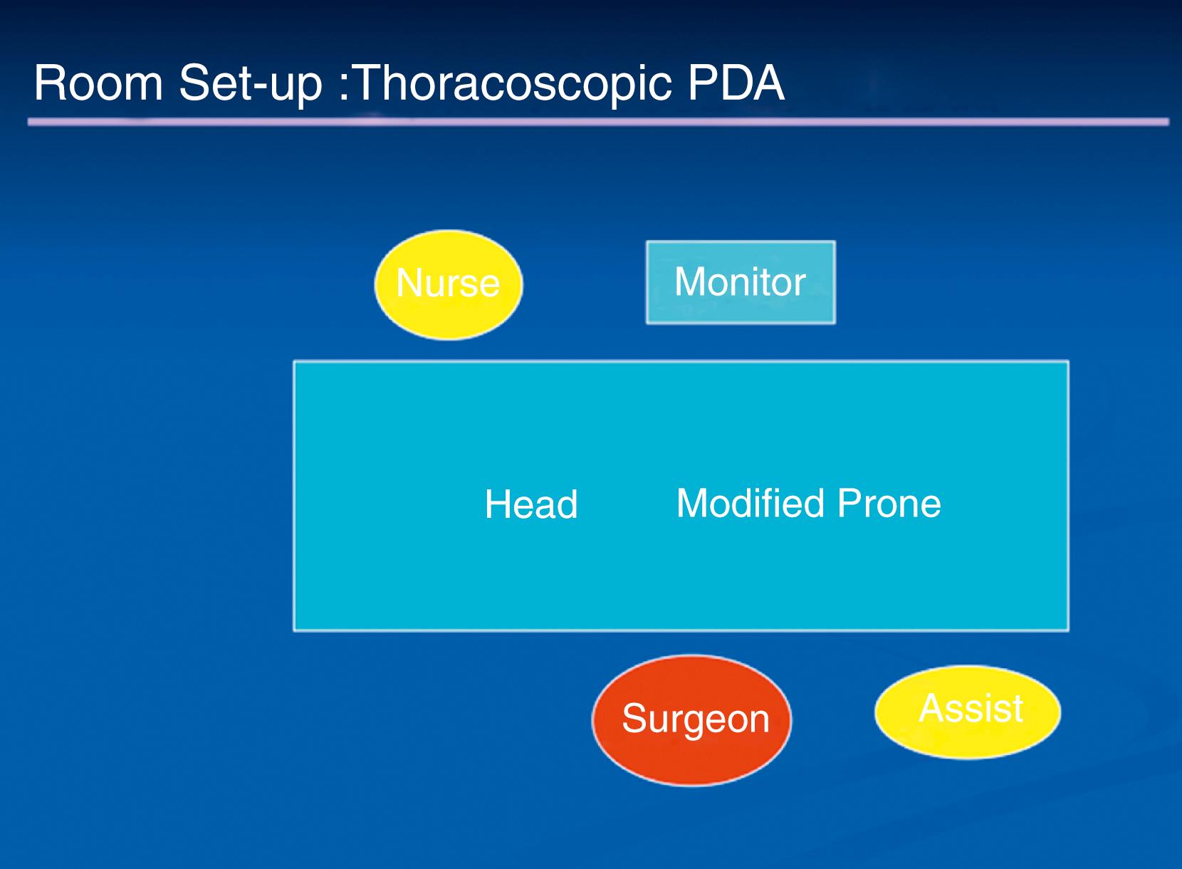 Fig. 39-1, The room and personnel setup for patent ductus arteriosus (PDA) ligation and division of vascular rings is shown.