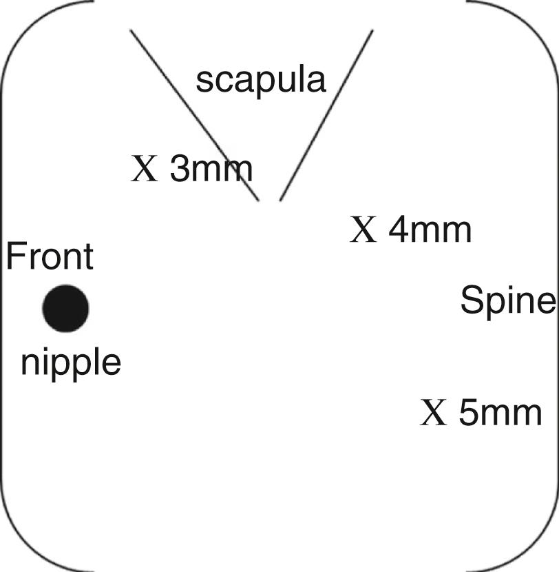 Fig. 39-2, The port positions for patent ductus arteriosus (PDA) ligation and division of vascular rings is similar. The 4-mm, 30-degree telescope is positioned just below and slightly behind the tip of the scapula. The surgeon’s left-hand port (3 mm) is located in the axilla and the surgeon’s right-hand port is one interspace below and slightly posterior.