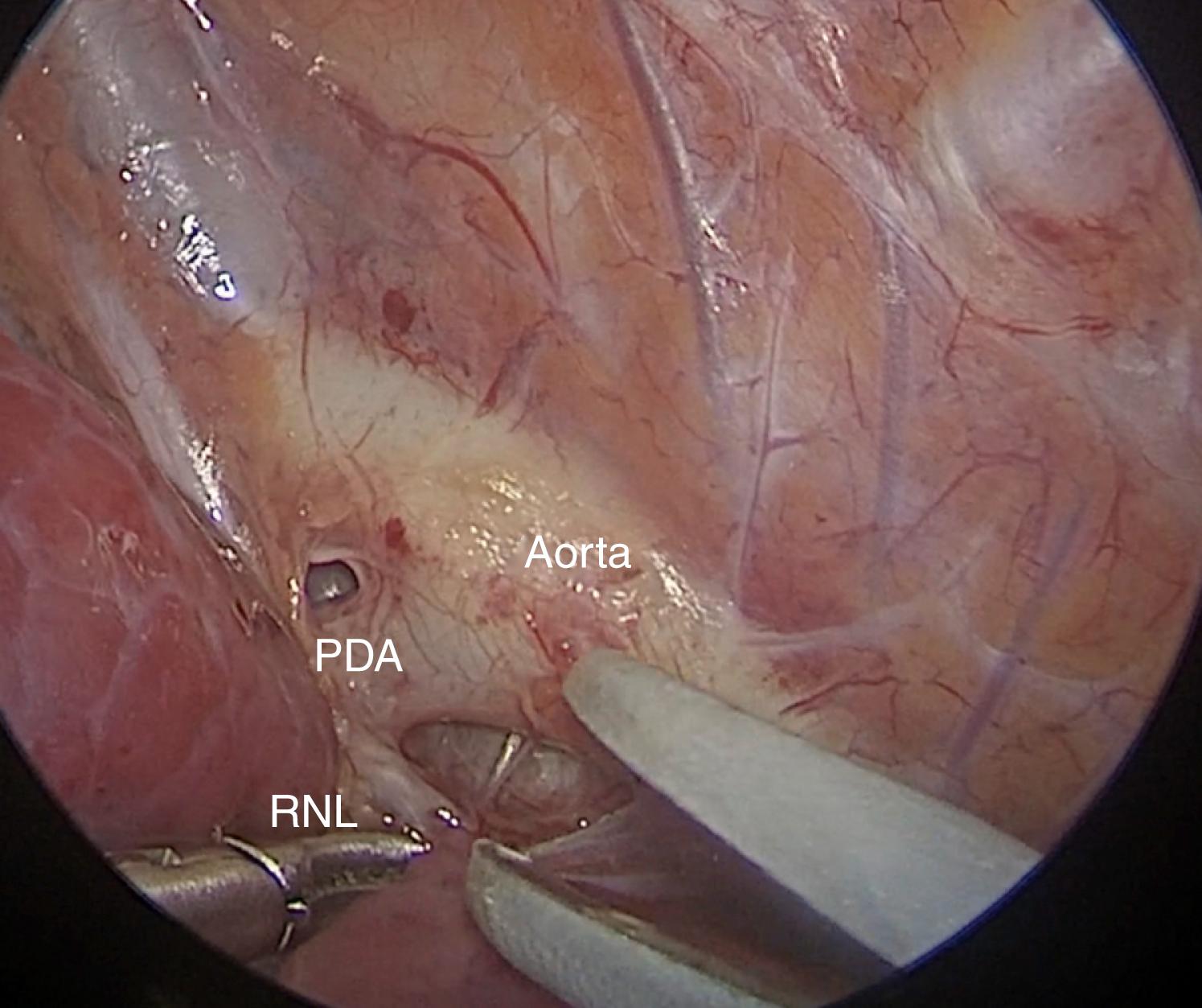 Fig. 39-4, This operative photograph shows that the patent ductus arteriosus (PDA) has been identified and mobilized after the pleural flap has been created to expose the PDA and recurrent laryngeal nerve (RLN).