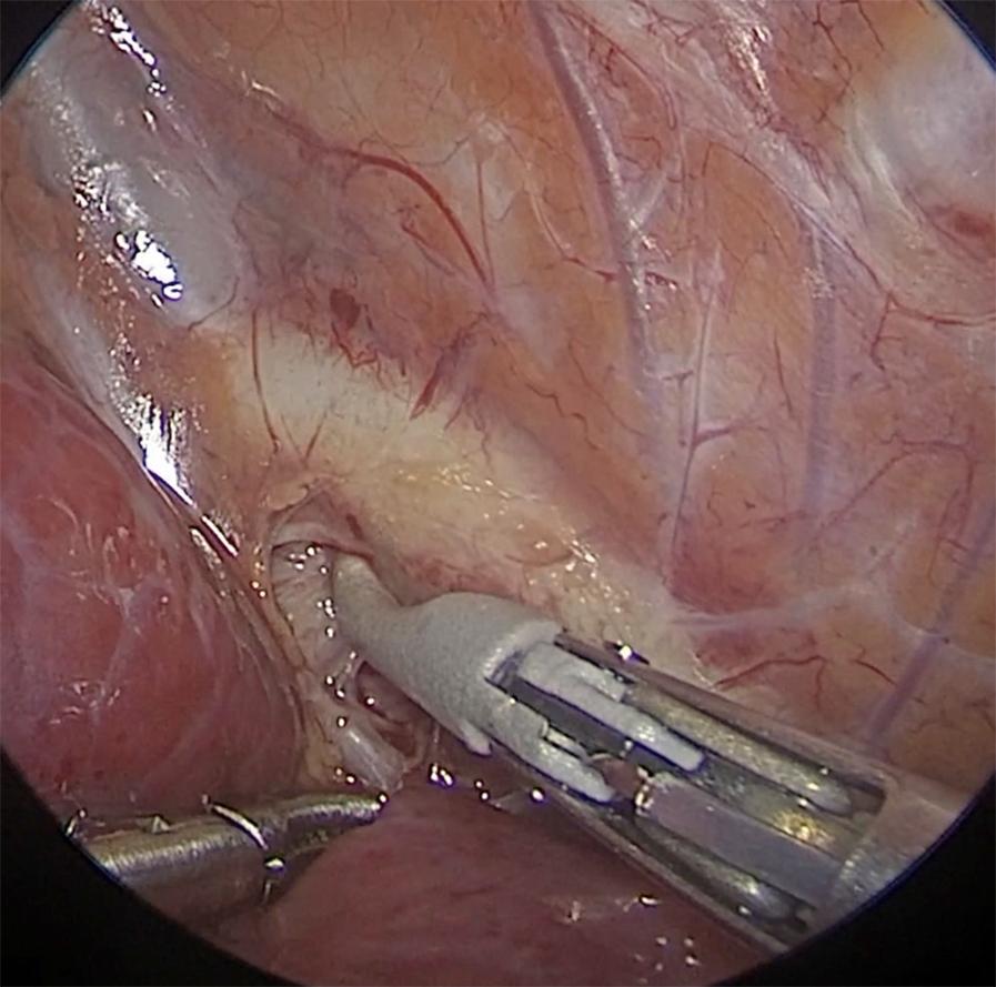 Fig. 39-5, Prior to ligating the patent ductus arteriosus (PDA), a test clamping is performed with either a 3-mm Maryland dissecting instrument or the 3-mm vessel sealer.