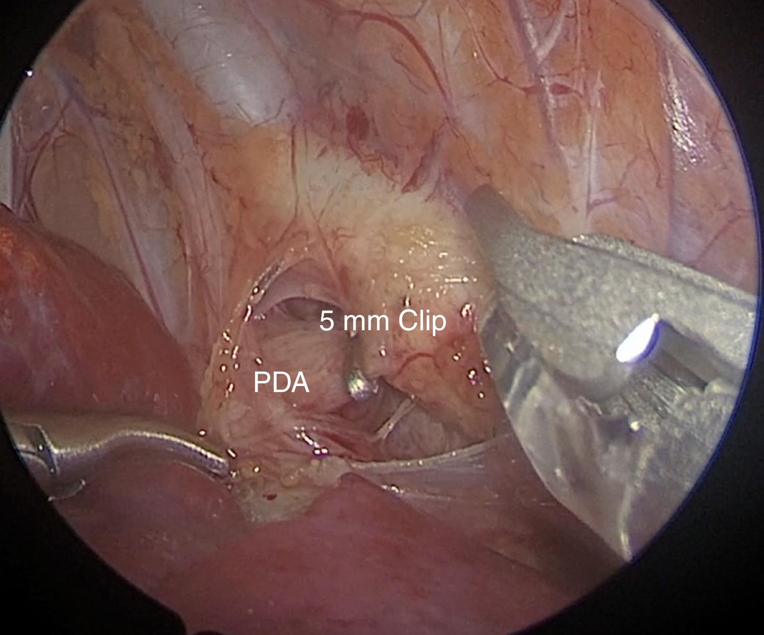 Fig. 39-6, After the successful test clamping, an endoscopic 5-mm clip has been positioned across the patent ductus arteriosus (PDA).