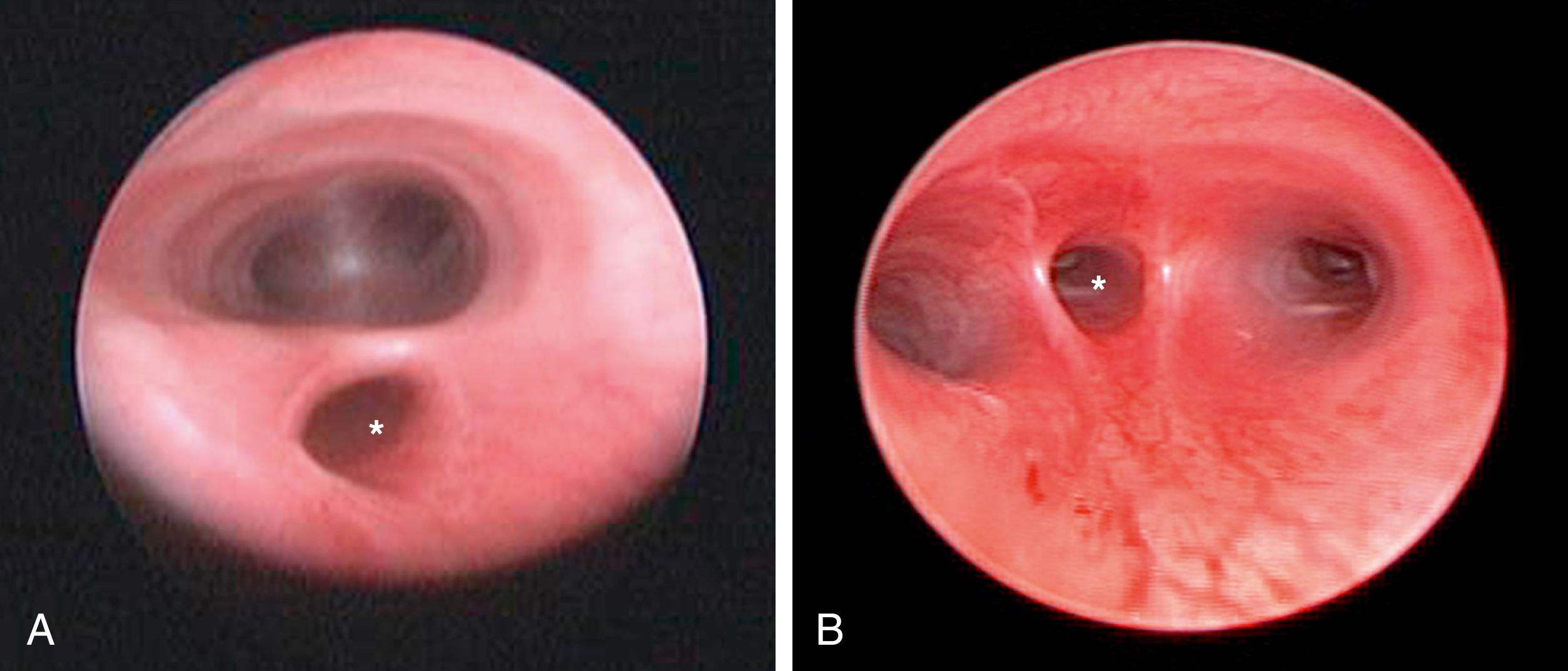 Fig. 37-1, These two photographs depict the distal tracheoesophageal fistula entering the trachea at different levels. A, The fistula (asterisk) enters in the midtrachea. B, The fistula (asterisk) enters at the carina.