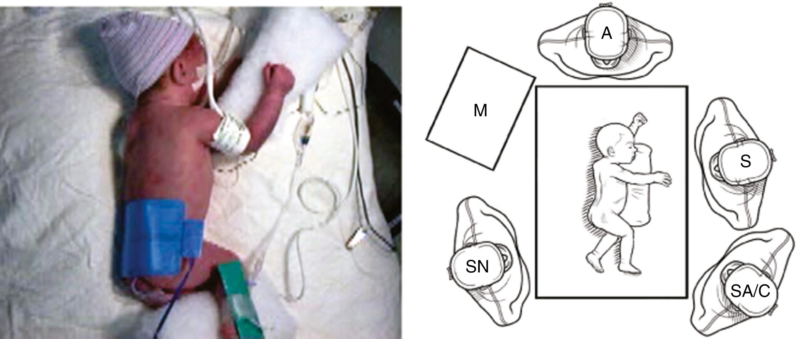 Fig. 37-2, Optimal positioning of the newborn for a thoracoscopic repair of esophageal atresia and fistula is shown. The infant should be placed in a modified prone position to allow the lung to fall away from the posterior mediastinum. The diagram shows personnel placement for this operation. The surgeon (S) and surgical assistant/camera holder (SA/C) stand at the front of the patient with the monitor (M) over the infant’s shoulder so that the area of dissection is in line between the telescope and camera and the monitor. The scrub nurse (SN) can be positioned depending on the surgeon’s preference. A , anesthesiologist.