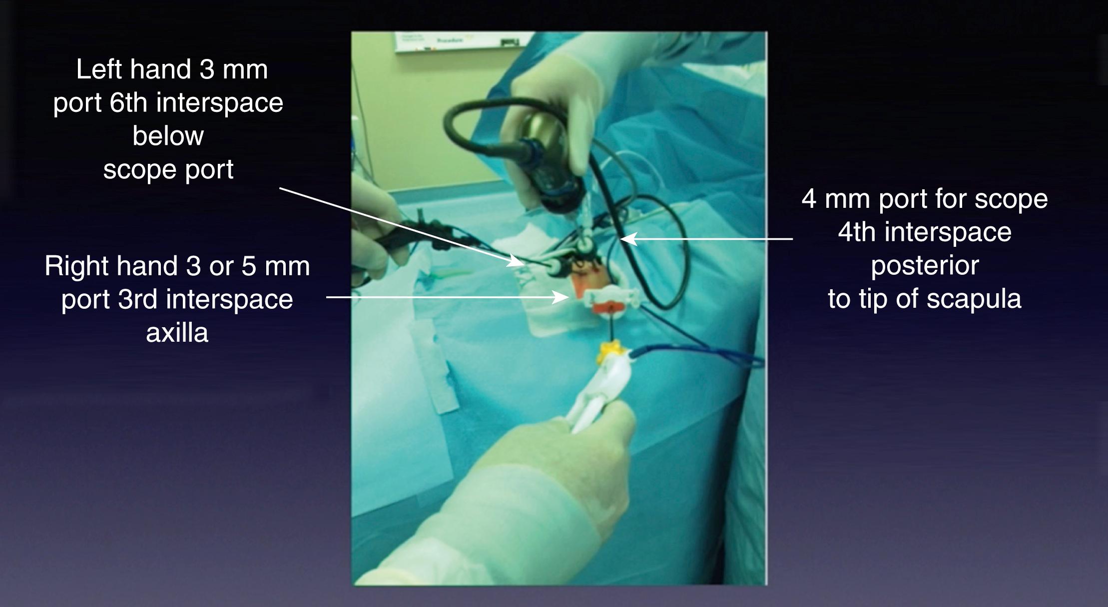 Fig. 37-3, Port placement for thoracoscopic repair of esophageal atresia and tracheoesophageal fistula. The initial cannula is introduced in the fourth or fifth intercostal space posterior to the tip of the scapula. This camera port allows excellent visualization of the posterior mediastinum with a 30- or 45-degree angled telescope. The two instrument ports are then introduced, one in the midaxillary line one to two interspaces above the camera site, and the other in the interspace below and slightly posterior. The upper port is 5 mm for introduction for the endoscopic clip applier, suture, and needle holder. The lower port is 3 mm in size. These ports should be situated so that when the instrument tips are introduced through them, they will approximate a 90-degree angle at the level of the fistula. A 3-mm instrument can be introduced in the lower thoracic cavity to help retract the lung if needed.