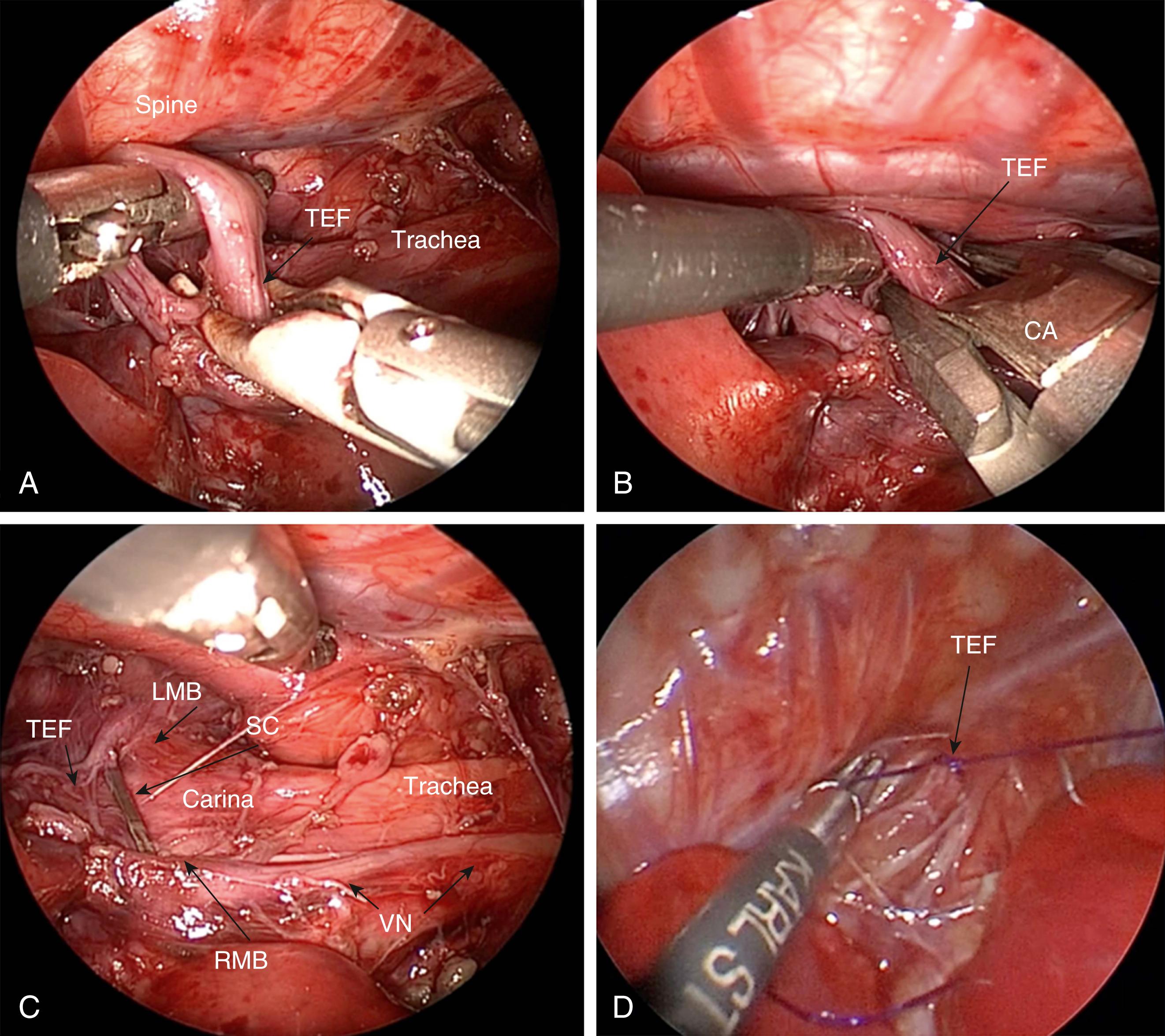 Fig. 37-5, A, The tracheoesophageal fistula (TEF) has been mobilized and is seen entering the membranous trachea. B, The TEF is being ligated with a 5-mm endoscopic clip applier (CA) . C, One surgical clip (SC) is usually adequate. In this case, the fistula arises at the carina. Care must be taken to identify the left mainstem (LMB) and right mainstem bronchus (RMB) to avoid inadvertent injury to these structures. D, The TEF is ligated with a 5-0 PDS in a 1-kg baby at the level of the membranous trachea. The distal esophagus is seen heading toward the diaphragm. VN , Vagus nerve.