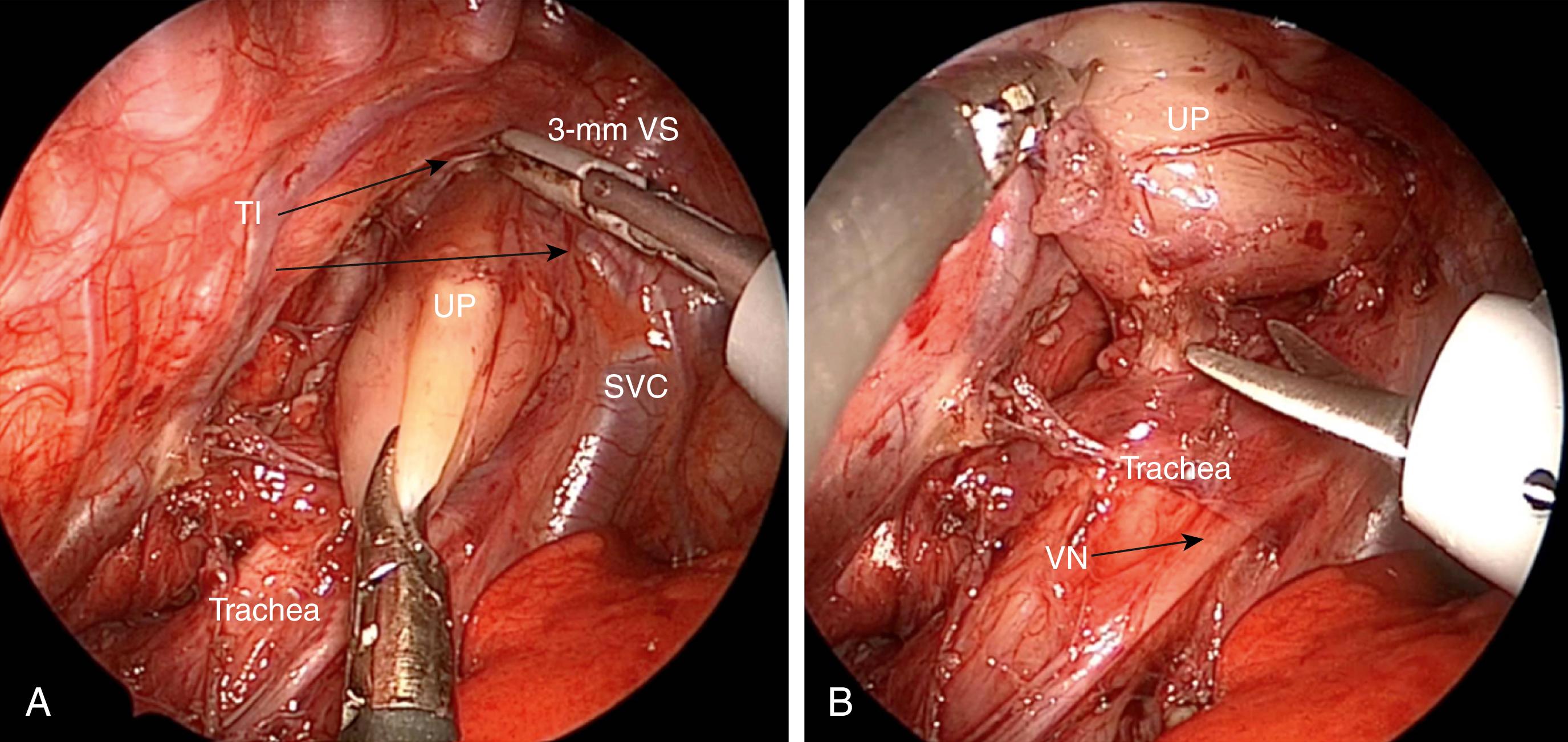 Fig. 37-6, A, The upper pouch (UP) is dissected up into the thoracic inlet (TI) using the 3-mm vessel sealer (3-mm VS) . The superior vena cava (SVC) is seen clearly. B, The plane between the UP and membranous trachea is also seen. Sharp dissection is used to separate the two structures. The vagus nerve (VN) is identified as well.