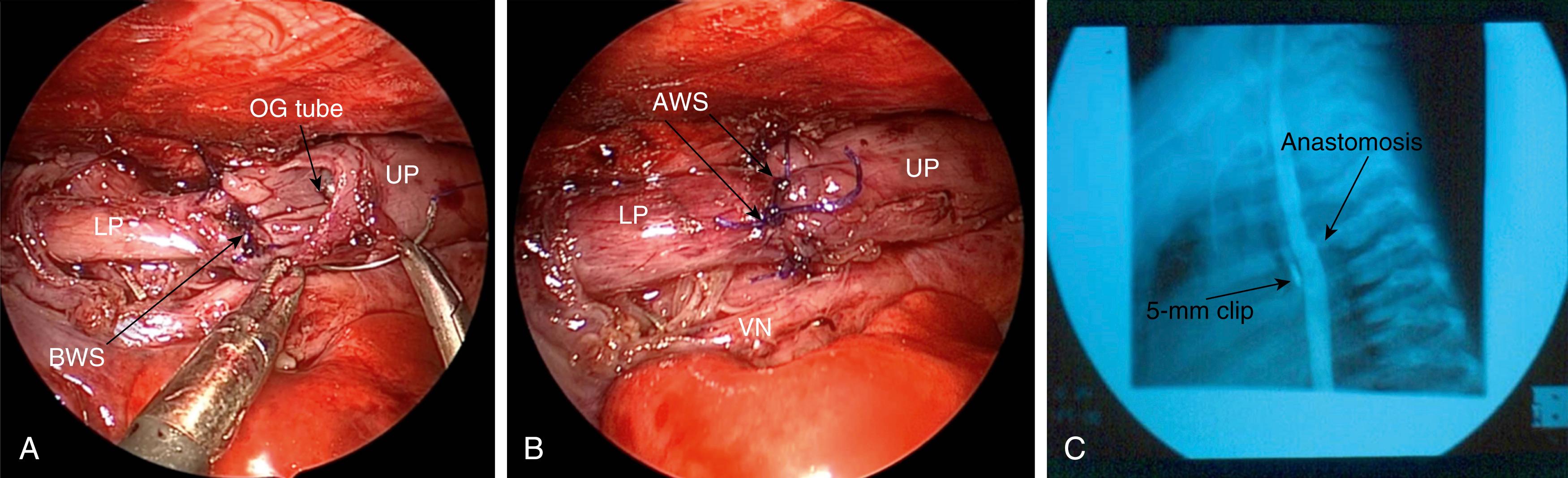 Fig. 37-7, The lower pouch (LP) is mobilized to create greater length. It can be freed all the way to the diaphragm if necessary. A, The back wall sutures (BWS) are placed and tied intraluminally. The orogastric (OG) tube can be seen sticking out of the upper pouch (UP) and is then passed into the LP. B, The completed anastomosis is seen. The anterior wall sutures (AWS) have been tied extraluminally. The OG tube is withdrawn once the front wall is complete. C, A contrast study on day 5 shows a patent, nonstrictured anastomosis. The 5-mm clip used to ligate the fistula is seen.