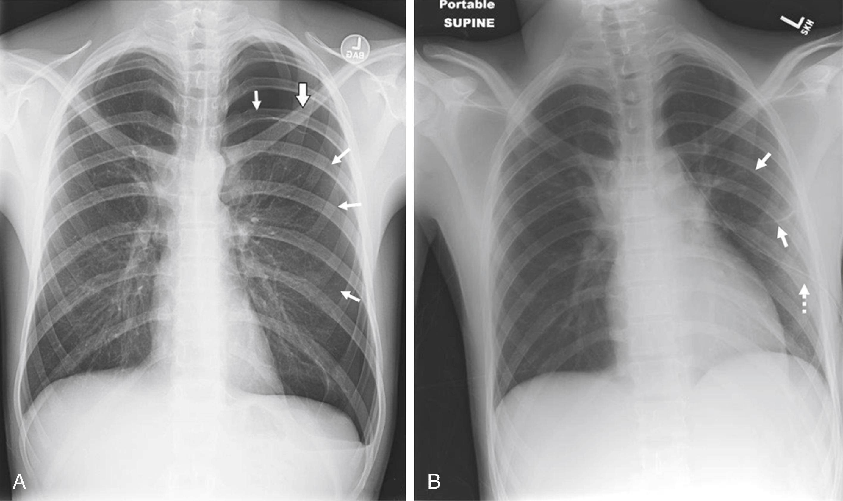 Fig. 35-2, A, This posteroanterior chest radiograph demonstrates a large left-sided subpleural bleb (large arrow) with an associated pneumothorax (small arrows). B, This posteroanterior chest radiograph demonstrates a large left-sided subpleural bleb (solid arrow) after tube thoracostomy (dotted arrow).