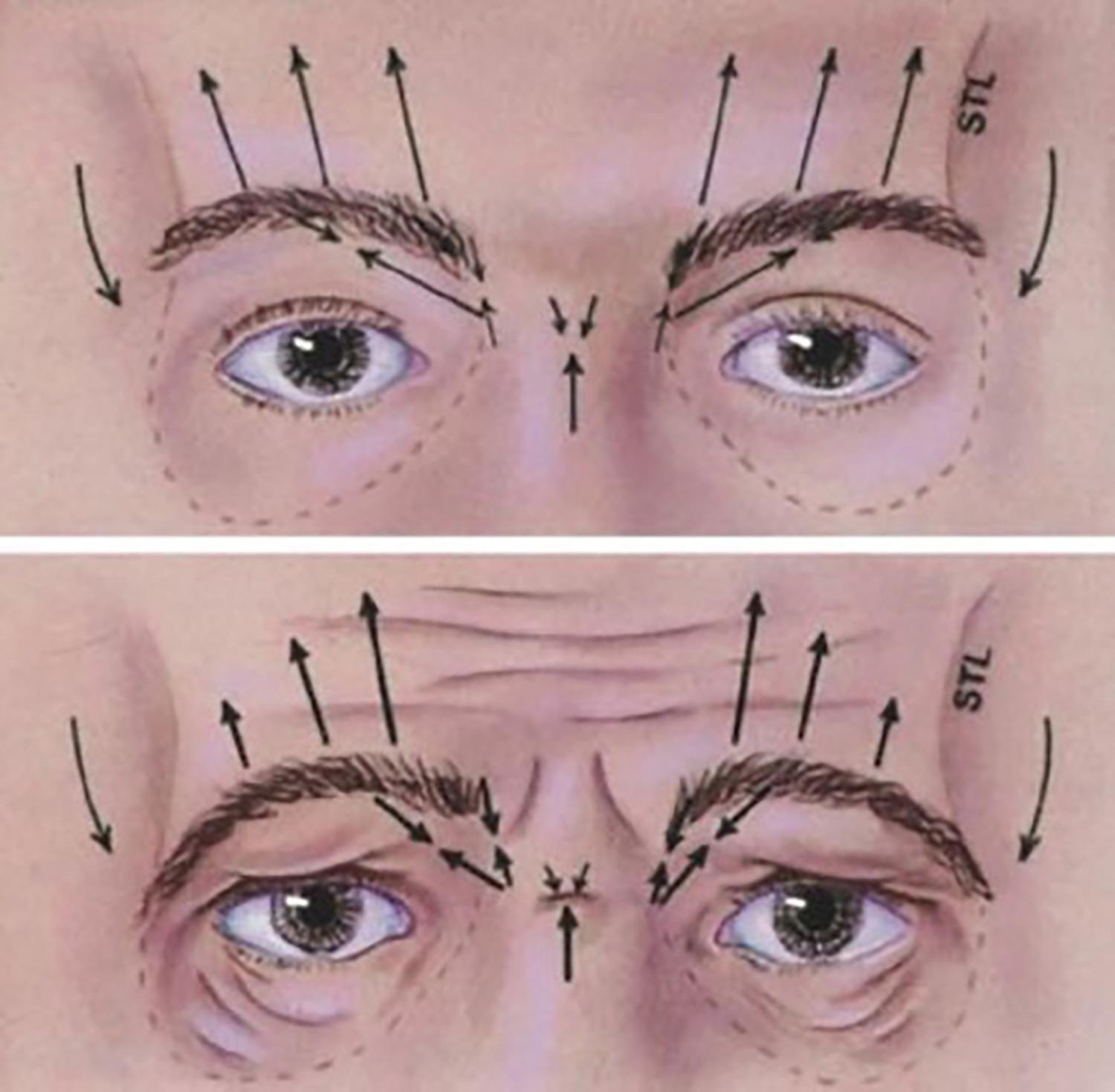 Fig. 18.1, The aging glabella and forehead.