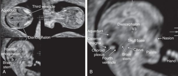 Fig. 173.1, Multiplanar display of the head of a normal fetus at 44 mm crown-rump length (corresponding to 11 postmenstrual weeks). The volume was acquired transvaginally with a median section and aligned anatomically. The reference dot is positioned in the third ventricle, and volume contrast enhancement (1 mm slice thickness) was used. (A) Multiplanar display of axial, coronal, and sagittal sections. (B) Sagittal section, reformatted from the same volume (selected anatomic structures labeled).