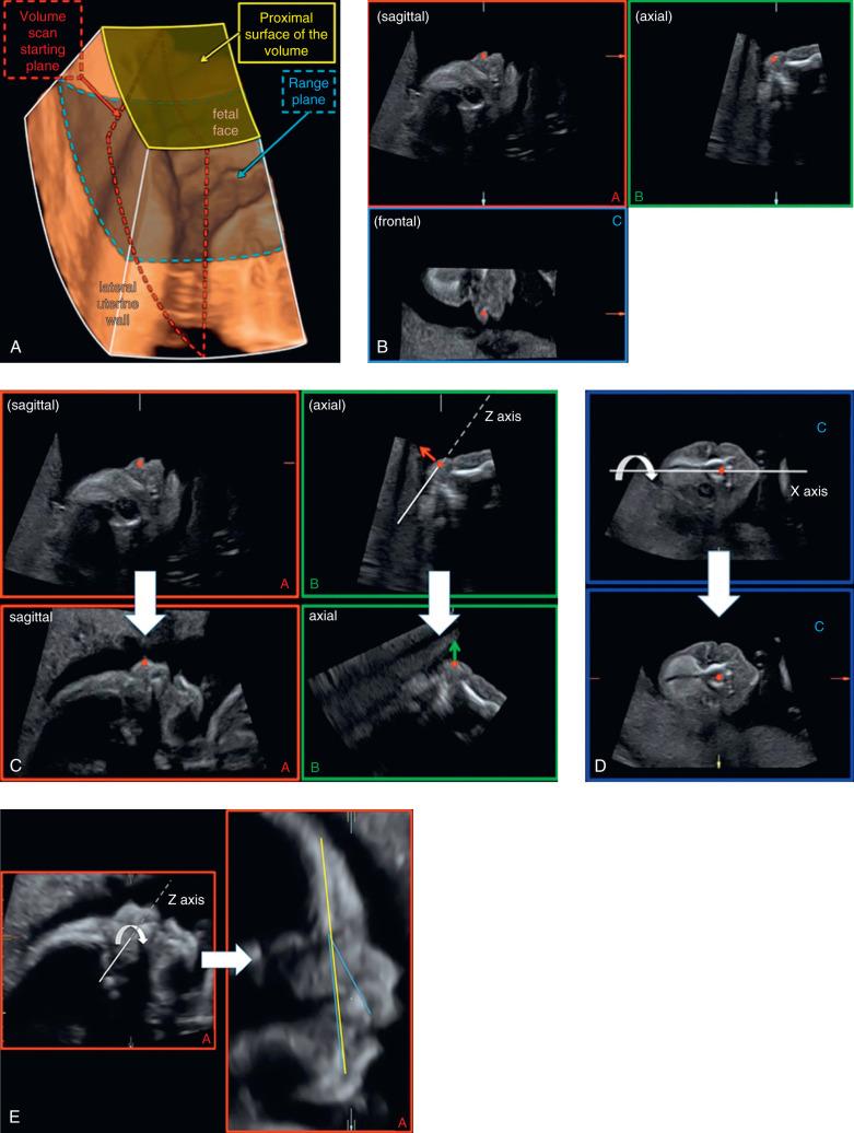 Fig. 173.2, Systematic approach to volume acquisition and stepwise alignment and rotation to extract the exact median section of a normal fetal face at 21 weeks' gestation (3). This volume was obtained from a fetus whose profile could not be obtained using real-time scanning because the fetus was facing to the side. First, the closest possible section to the profile was selected as the starting scan. Panels B to E show the stepwise extraction and eventually, analysis of the profile. (A) After volume acquisition a data block is stored, but usually not displayed. To understand the alignment better the entire volume block is shown, and the volume scan starting plane (red) and the range plane (blue) are indicated. (B) The reference dot is the intersection of the three orthogonal planes (highlighted as a red dot in near-sagittal, axial, and frontal sections in panels A, B, and C). In the multiplanar display the reference dot is placed on an easily recognizable structure, e.g., the tip of the nose. (C) Using the volume rotation in panel B, the direction of the nose is turned upright (red and green arrows), using rotation around the Z-axis (so-called in-plane rotation). (D) Then, the apparent nonalignment in panel C is adjusted to show the frontal view, using rotation around the X-axis in plane C. (E) Finally, the perfectly aligned, exactly median profile is rotated upright and studied, using the maxilla-nasion-mandible angle (blue lines) and the facial profile line (yellow line).