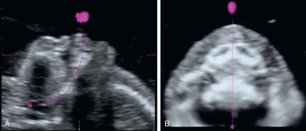 Fig. 173.3, Reconstruction of the normal fetal palate, using a curved plane. A frontal insonation of the fetal profile with transducer parallel to the frontal edges of the maxilla and the mandible was used to acquire the volume. The curved reconstruction plane (placement shown by the purple line in the sagittal section [A]) displays the entire hard and the soft palate down to the uvula in (B).