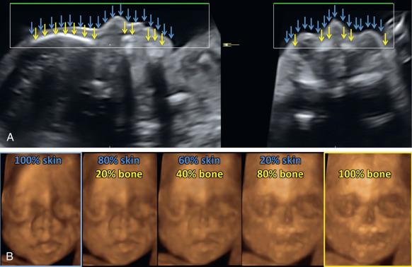 Fig. 173.5, Three-dimensional US surface rendering of the fetal face. All images in this figure were reformatted from the same volume that had been acquired using frontal insonation. For such a volume, ideally at least a small amount of amniotic fluid should be present between the face and other echogenic structures beneath the transducer. (A) Sagittal and axial sections: the adjustable render box (white lines) determines what the algorithm will display in 3D. The green line defines the direction of rendering (not necessarily, but in this example also the direction from which the object is viewed), in this example from the front. The blue arrows define the soft tissues seen in the display in (B), the yellow arrows define the bones. (B) The same volume can be “rendered” (surface-reconstructed) for either the skin surface (“100% skin,” far left) or the bone surface (“100% bone,” far right), or a mix of both. Note the absent ossification of both nasal bones apparent in the far-right image of (B) in this fetus with trisomy 21.