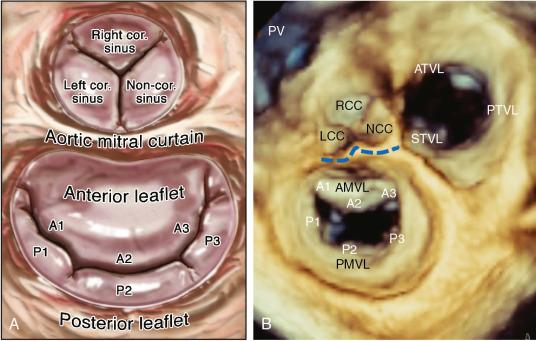 Fig. 2.1, Schematic diagram (A) and en face 3DE zoom mode image (B) of the mitral valve from the LA or surgeon’s perspective depicts typical anatomic relationships. In this view, the aortic valve occupies the 12-o’clock position. The aortic-mitral curtain separates the anterior leaflet from the aortic valve. The Carpentier system divides the posterior leaflet into three scallops (P1, P2, P3) based on leaflet indentation. The anterior leaflet is then divided and classified as three segments based on their relationship to the posterior leaflet (A1, A2, A3) . AMVL , Anterior mitral valve leaflet; ATVL , anterior tricuspid valve leaflet; LCC , left coronary cusp; NCC , noncoronary cusp; PMVL , posterior mitral valve leaflet; PTVL , posterior tricuspid valve leaflet; PV , pulmonary valve; RCC , right coronary cusp; STVL , septal tricuspid valve leaflet.