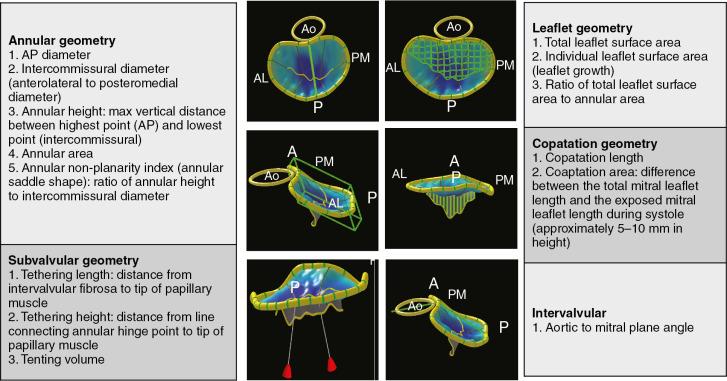 Fig. 2.3, Volumetric reconstruction of the mitral valve with 3DE-based software allows measurements of mitral annulus, leaflet, coaptation line, intervalvular relationships, and subvalvular geometry. A , Anterior; Ao , aortic valve; P , posterior.