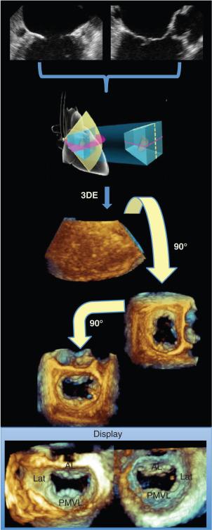 Fig. 2.4, 3D TEE Acquisition and Presentation of the Mitral Valve.