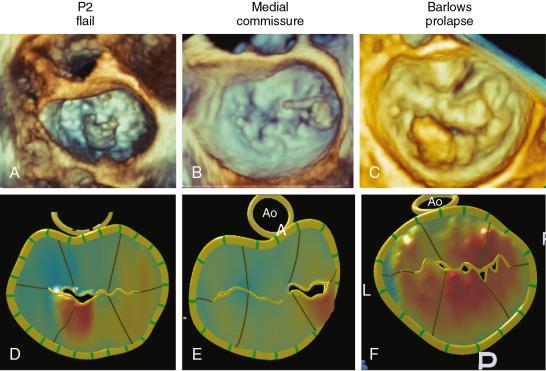 Fig. 2.6, En face 3D TEE images of the mitral valve as viewed from the LA demonstrate flail P2 segment (A) due to fibroelastic deficiency, flail medial commissure segment (B); and bileaflet prolapse (C) in a patient with Barlow disease. The corresponding parametric maps are for P2 flail (D), medial commissure flail (E), and Barlow disease (F), in which the color gradations toward orange indicate the distance of the leaflet from the mitral annular plane toward the LA. A , Anterior; AL , anterolateral; Ao , aortic valve; P , posterior.