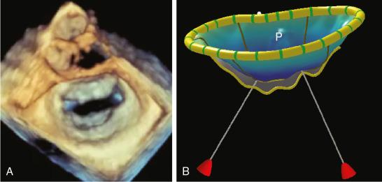 Fig. 2.8, (A) En face 3D TEE image of a mitral valve as viewed from the LA demonstrates symmetric bileaflet tethering due to dilated cardiomyopathy. (B) Corresponding parametric map depicts apical displacement of the chordae and subsequent tethering of both leaflets. P , Posterior.