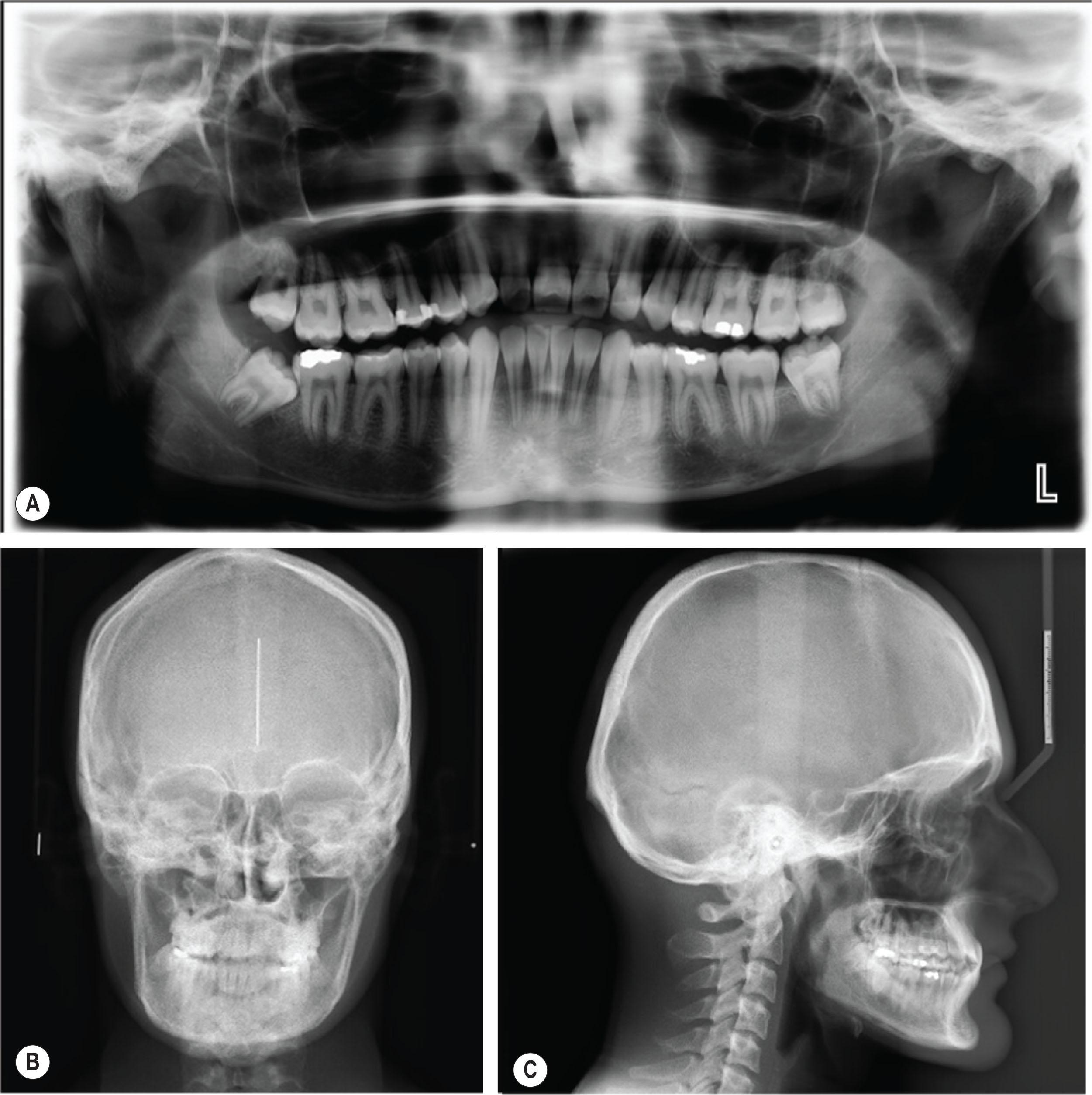 Figure 6.2.1, Traditional two-dimensional images for orthognathic surgical treatment planning. Panoramic radiographs (A) , posterior–anterior (B) , and lateral (C) cephalograms have been historically used to assist with the diagnosis and surgical–orthodontic correction of dentofacial deformities.