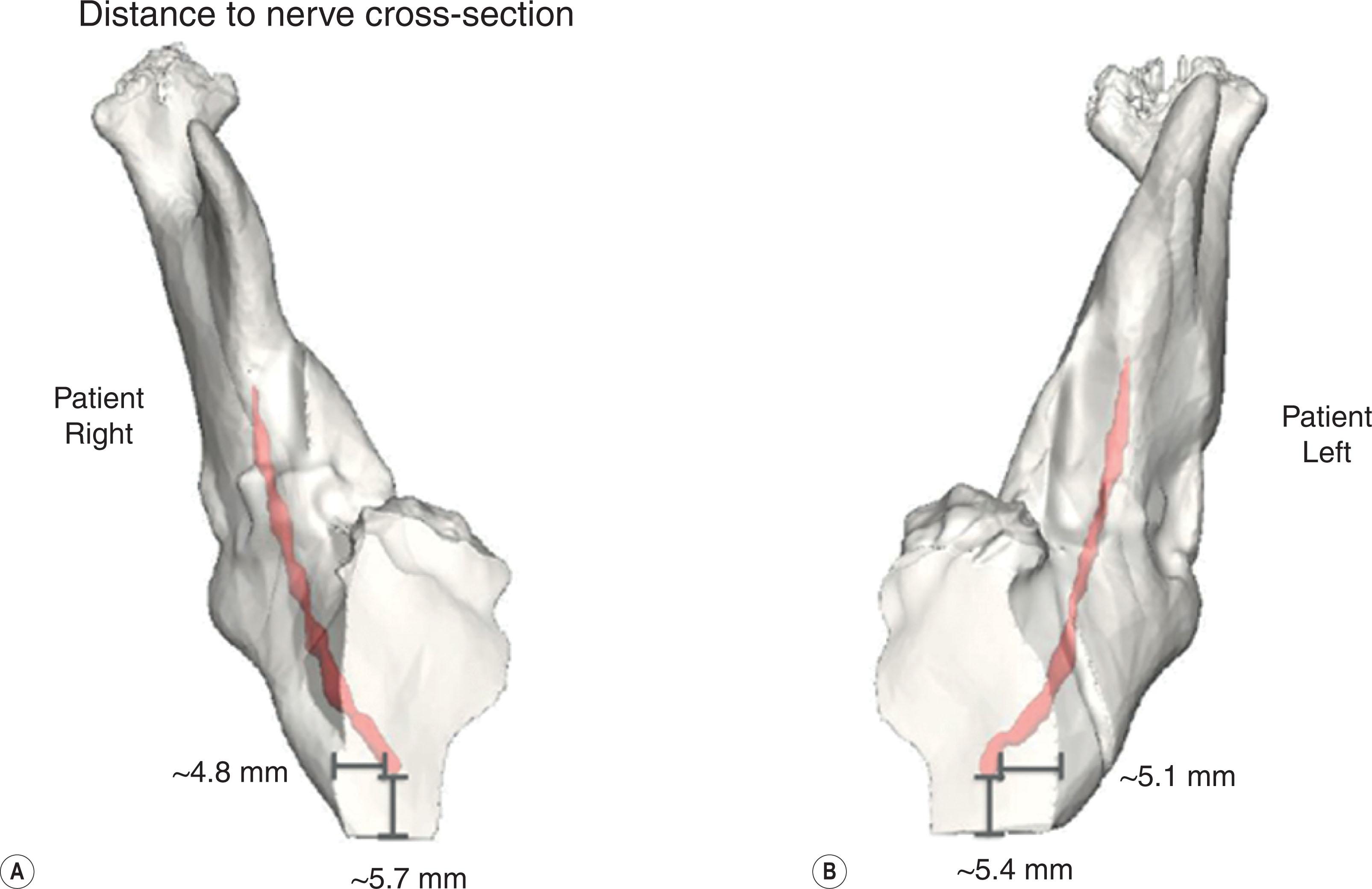 Figure 6.2.11, Virtual surgical planning is also helpful for visualizing the course of critical anatomic structures, such as the inferior alveolar nerve. This patient with congenital micrognathia underwent mandibular distraction in infancy. The course of the inferior alveolar nerve was atypical and virtual surgical planning was informative for determining the course of the inferior alveolar nerve (pink) to carefully execute a sagittal split osteotomy and avoid iatrogenic injury.