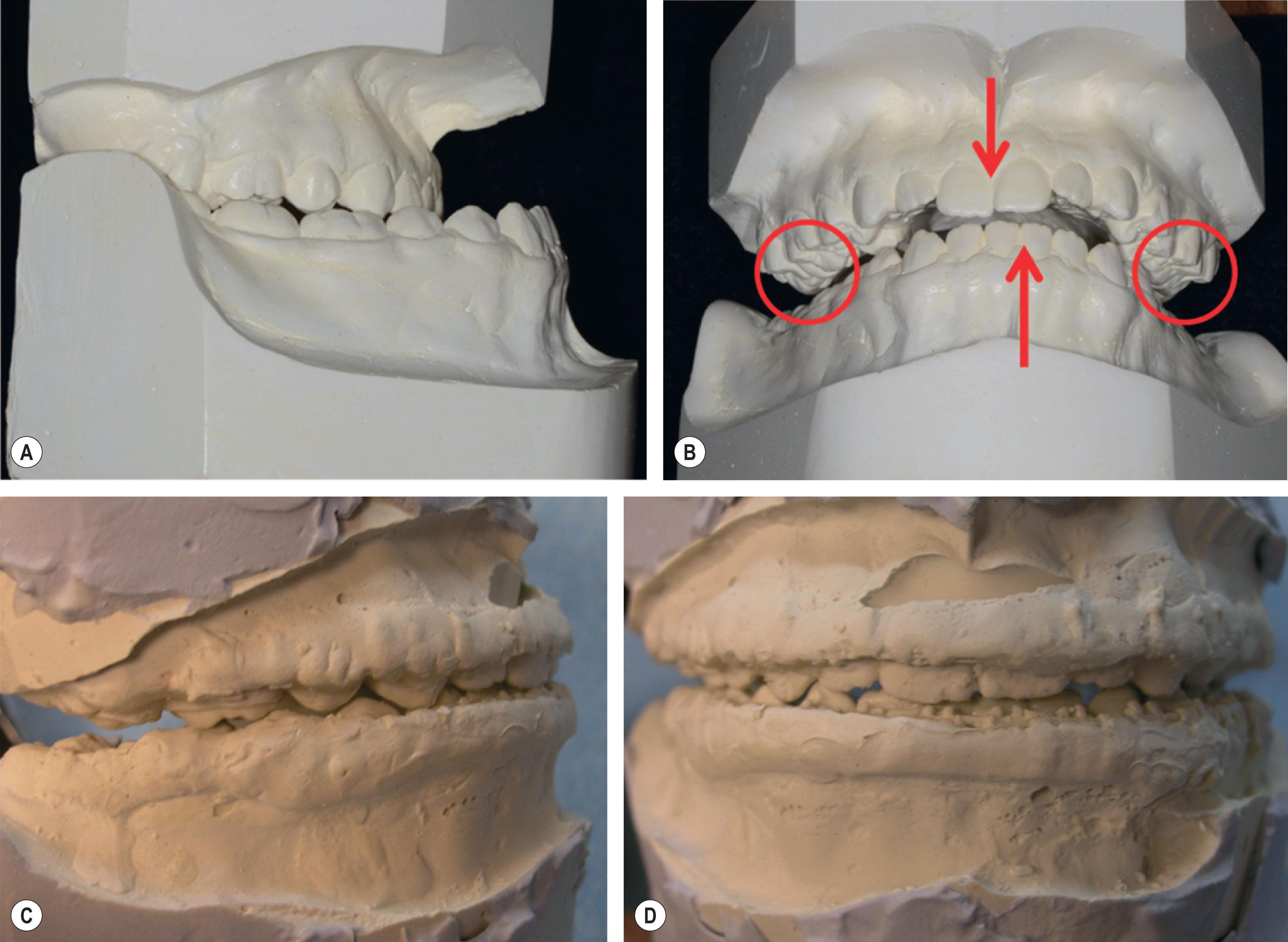 Figure 6.2.13, (A) Pre-orthodontic study models. (B) Posterior transverse and anterior midline discrepancies (red arrows) after hand articulation of pre-orthodontic treatment study models in the anticipated postsurgical position. (C,D) After completion of pre-surgical orthodontic treatment with the extraction of the maxillary right and left first premolars and decompensation of malocclusion. Note the coordination of the posterior dental arch width and the maxillary and mandibular midlines.