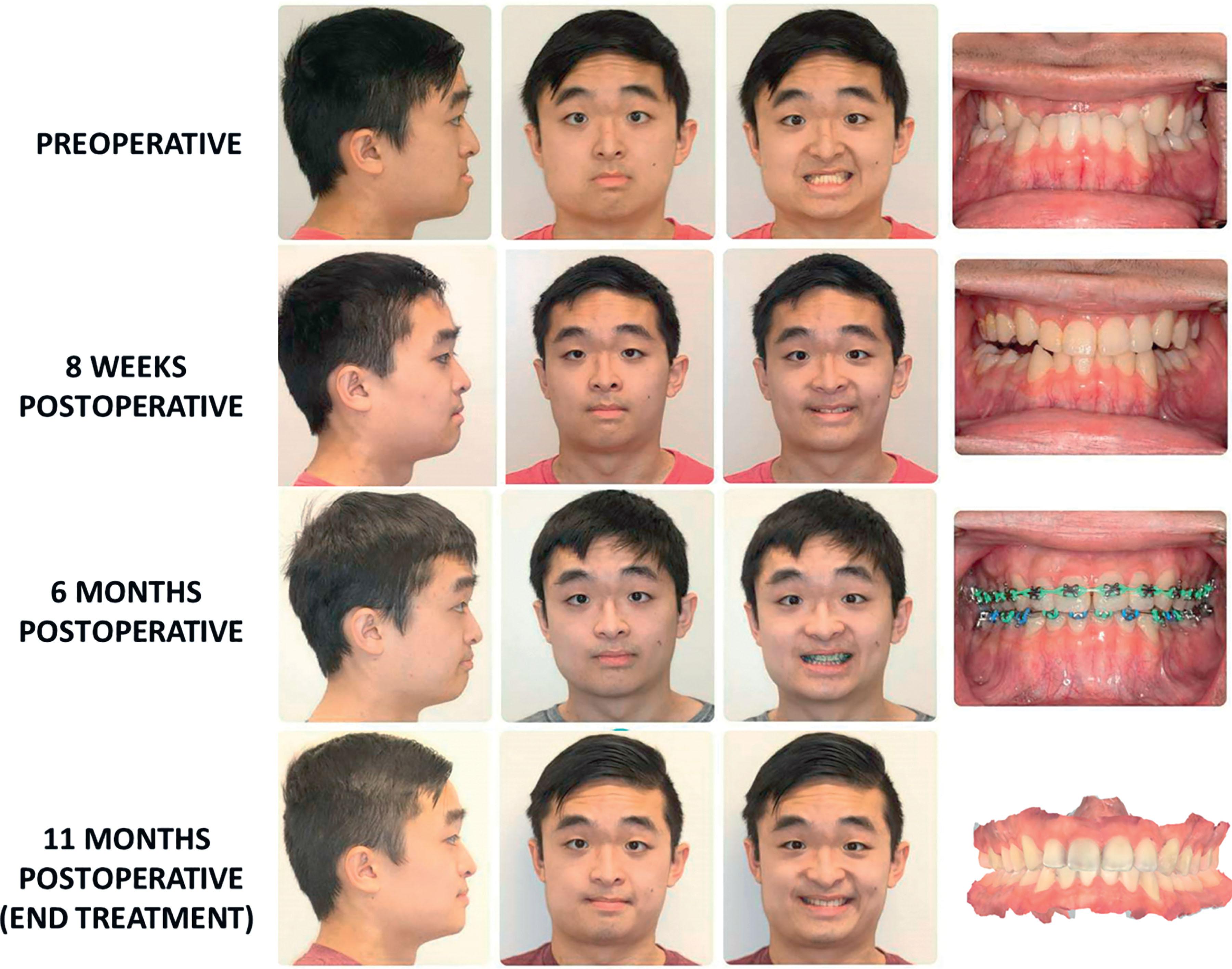 Figure 6.2.14, This patient with type I neurofibromatosis was diagnosed with maxillary sagittal hypoplasia. The mandibular position was appropriate and there was no facial asymmetry. A surgery-first approach was undertaken, utilizing a Le Fort I osteotomy with sagittal advancement. At 6-months postoperatively, orthodontic coordination was largely complete. The patient completed orthodontic treatment at 11 months postoperatively. (Orthodontic care provided by Hitesh Kapadia, DDS, PhD.)