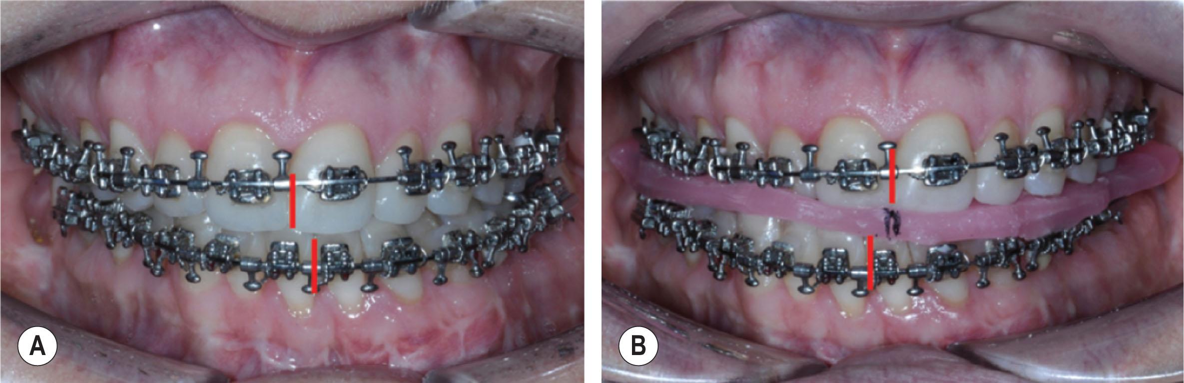 Figure 6.2.16, A patient in the maximal intercuspal position (occlusion with greatest tooth contact). Note the mandibular midline to the left of the maxillary midline (A) . A patient photograph taken with the mandible in centric relation ( B , condyles in centric relation in the condylar fossa).