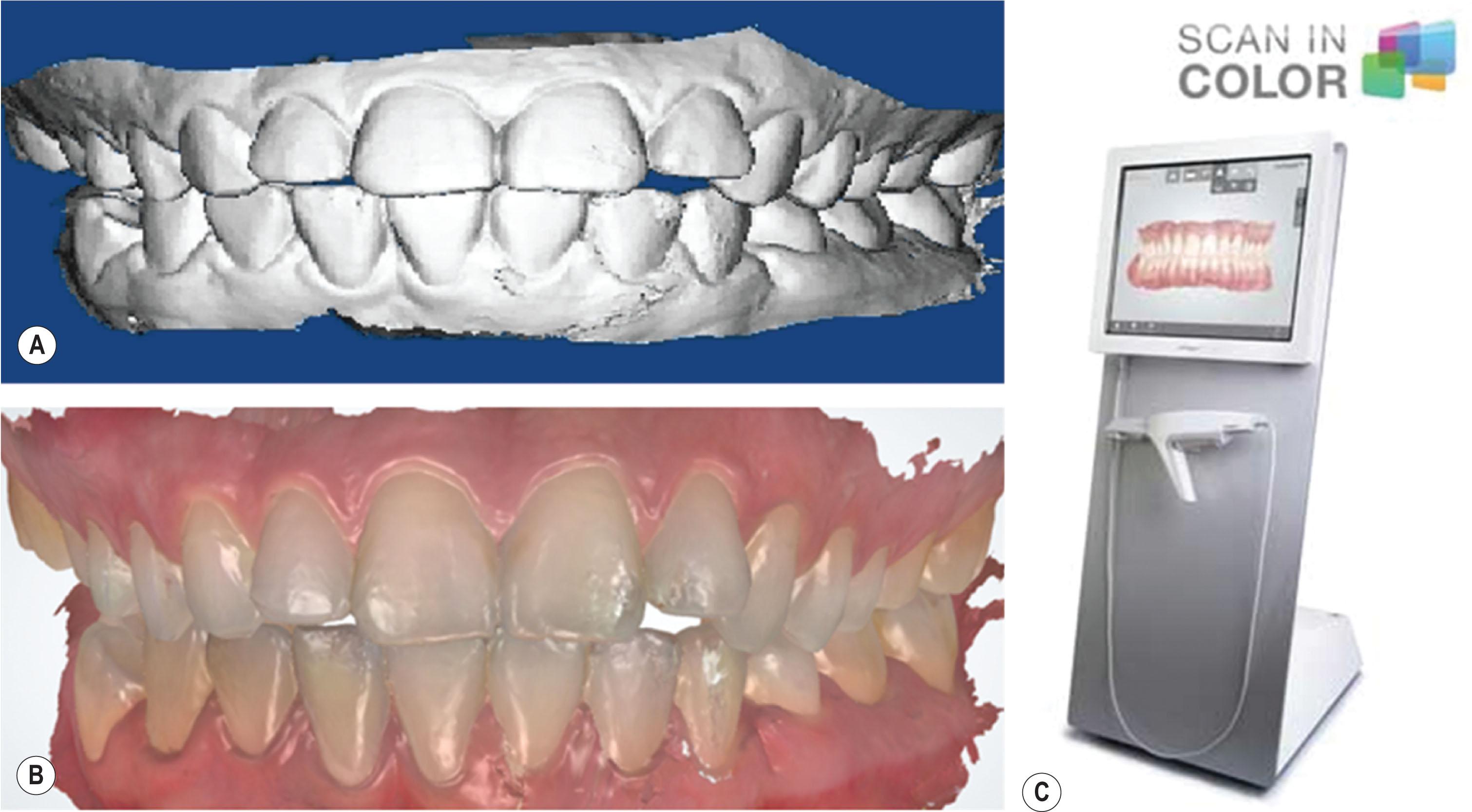 Figure 6.2.17, Digitally rendered occlusal models (A) , a 3D intraoral dental scan (STL file format, B ) acquired with a Trios intraoral scanner (C) from 3Shape.