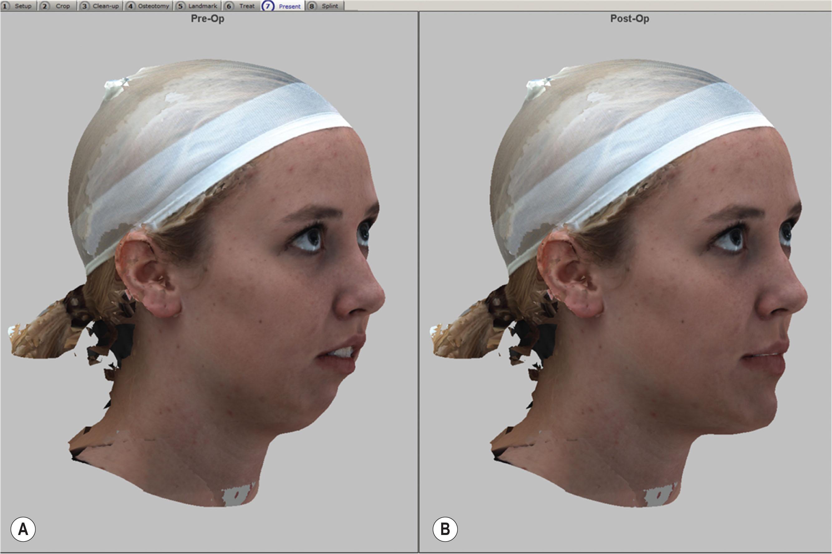 Figure 6.2.18, Pre- (A) and postsurgical (B) simulation prediction for a patient who will to undergo two-jaw surgery. In these images, the 3D photograph opacities have been changed, and the CBCT data and 3D dental scan are invisible. This simulation is used for patient education and for understanding the patient’s expectations from surgery.