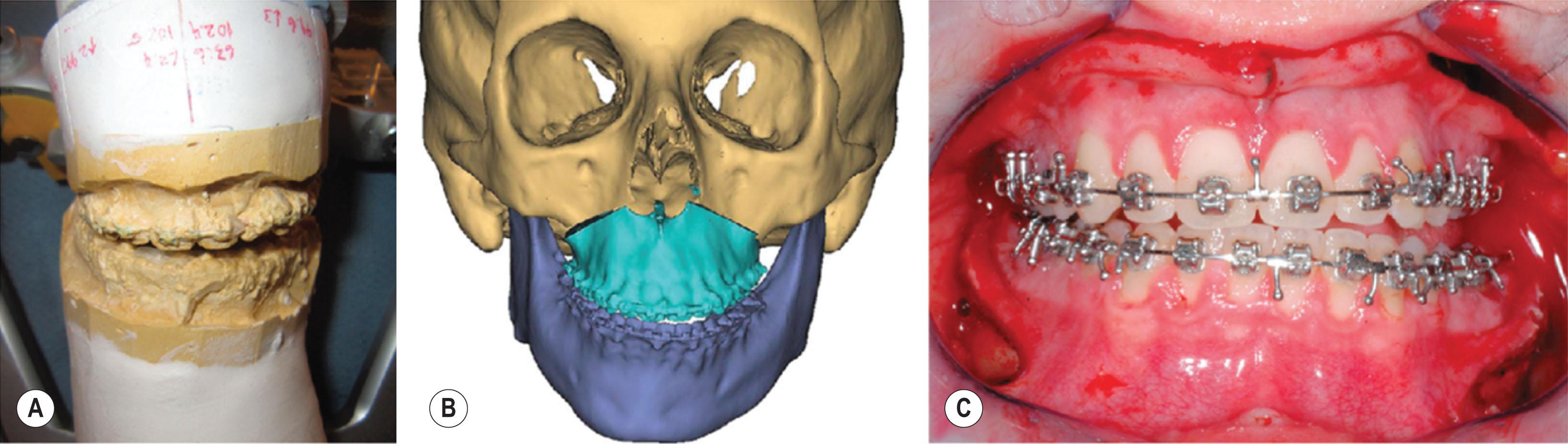 Figure 6.2.2, Traditional orthognathic model surgery entails obtaining dental cast models and mounting them on a semi-adjustable articulator (A) , used to simulate the arch of mandibular rotation. This arc of rotation can also be simulated in the virtual environment to generate the intermediate position in two-jaw surgery (B) . Alteration of the mounted cast position to the desired tooth movements is then completed and translated to the operative environment (C) with the use of an acrylic splint.