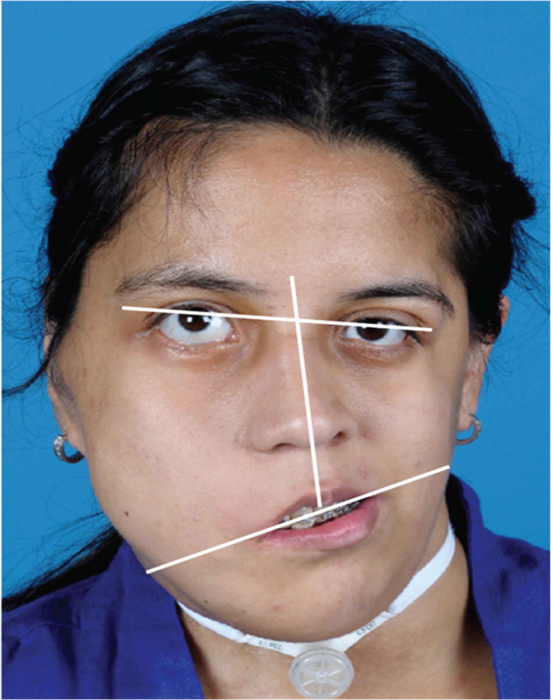 Figure 6.2.4, A patient with significant facial asymmetry, including orbital dystopia and discrepancy with the position of her ears. This constellation of facial differences makes obtaining an accurate facebow transfer challenging. Discrepancies in the registration translate to errors in mounting dental study models on an articulator to accurately represent the orientation of the model to the craniofacial skeleton and ultimately adversely affect the intra-operative positioning of the jaws.