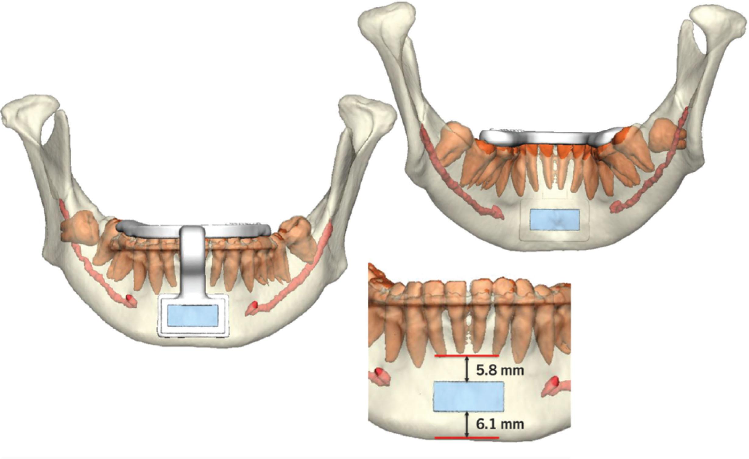 Figure 6.2.5, Tooth-borne polyamide guide designed for genioglossus advancement. Custom guide designs are helpful for precision osteotomies to avoid the tooth roots while also capturing the genial tubercles.